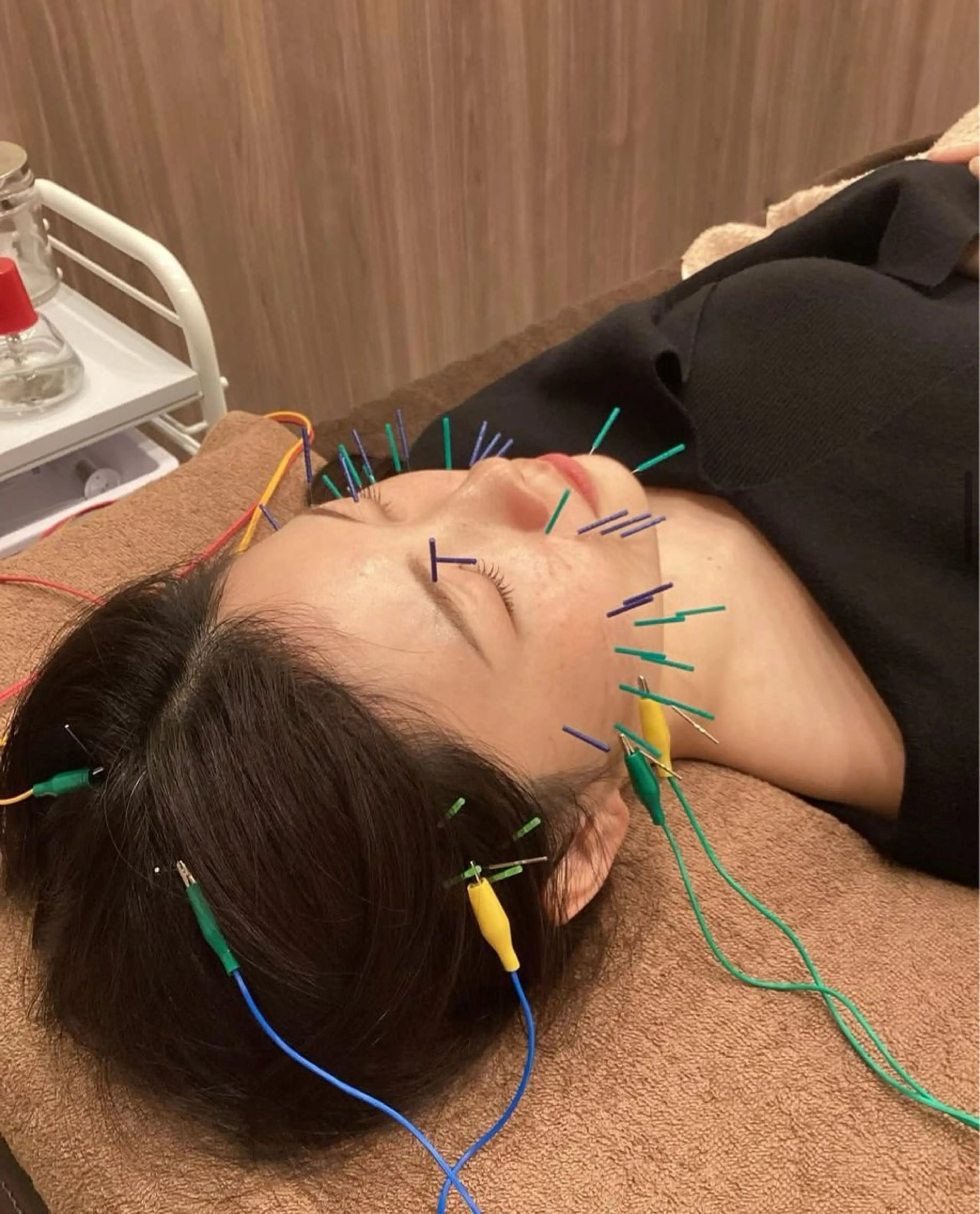 🪡🇰🇷BASIC美容鍼✖️LHALA PEEL:ララピールの写真