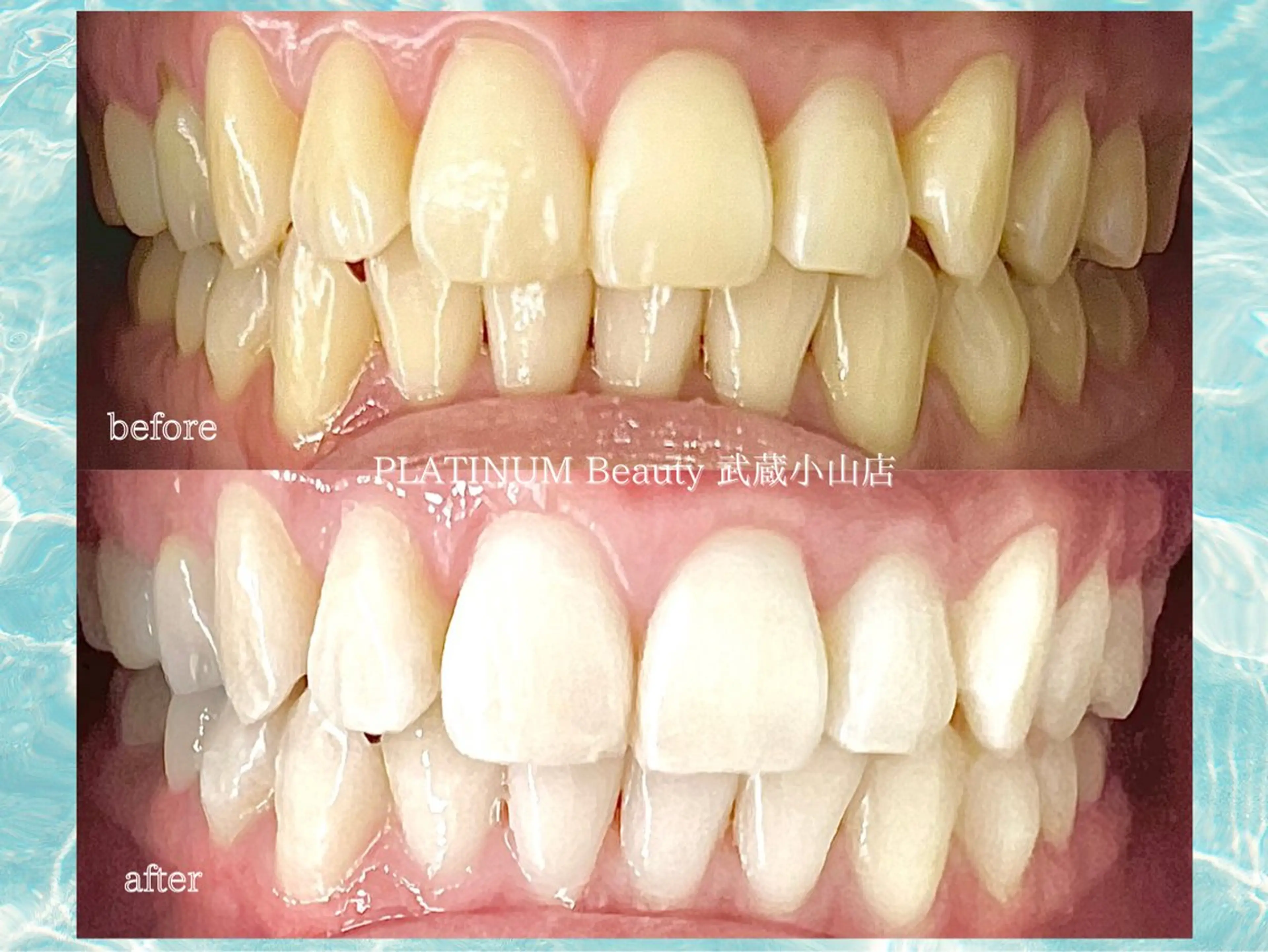 minimo限定【ナチュラルセルフホワイトニング】 トーンUP！25分照射！初回限定！の写真