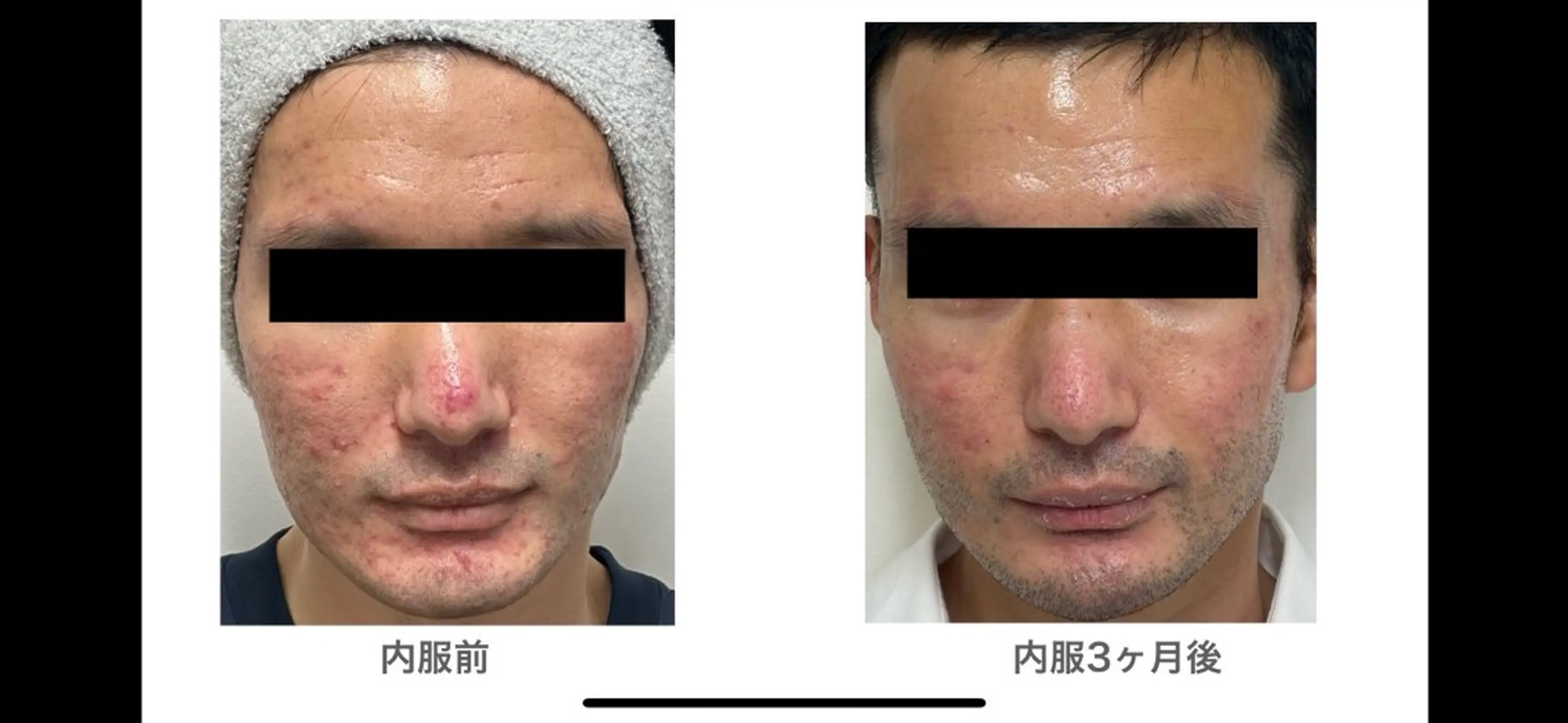 【赤ニキビ改善】 BELL'ET新宿店のエステ・リラクイメージ