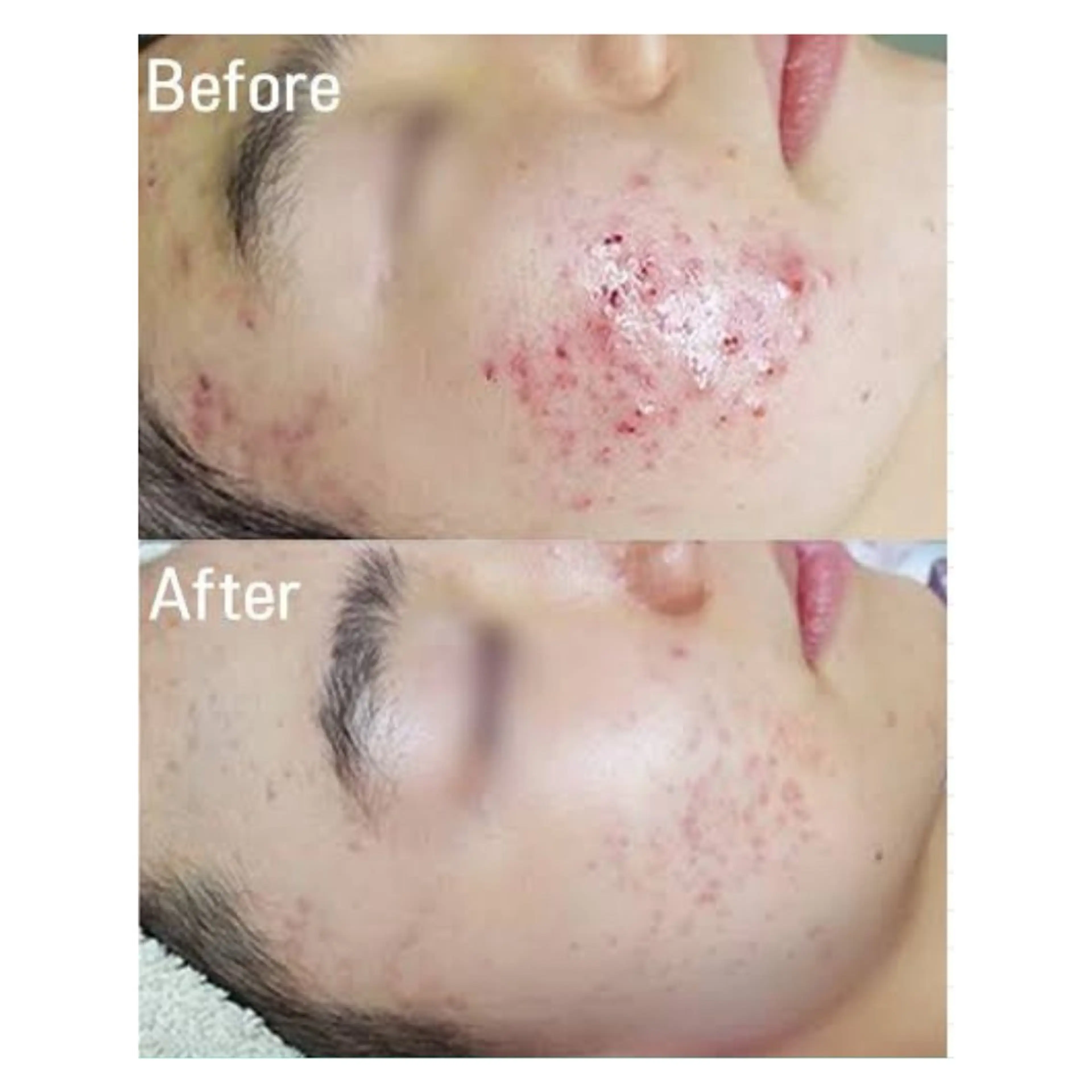 「毛穴・肌をリセットして立て直す！」577万本植え込みハーブピーリング【トロイピール】の写真