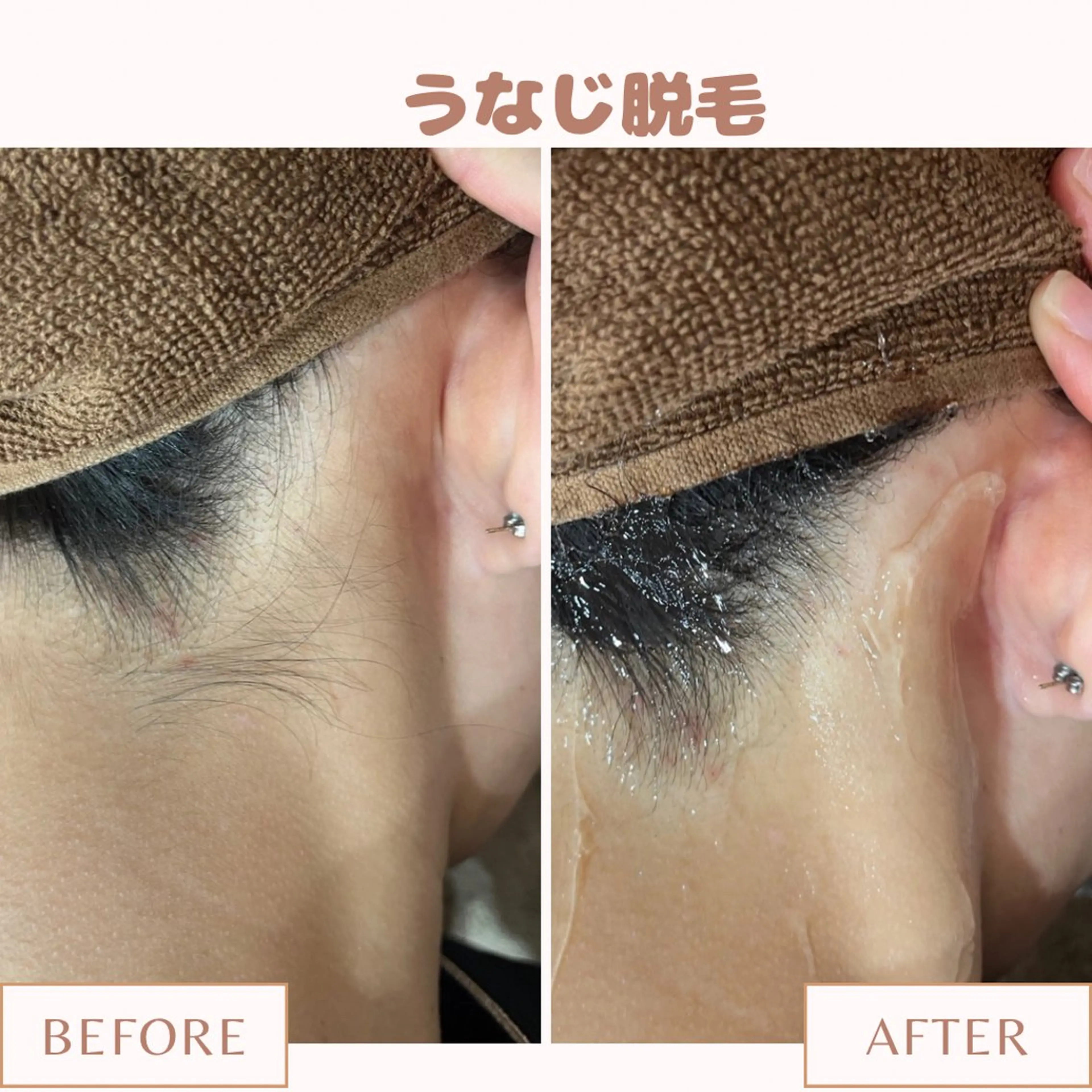 【シェービングのみ】💙うなじ・背中全面シェービング プラセンタ保湿付💙の写真