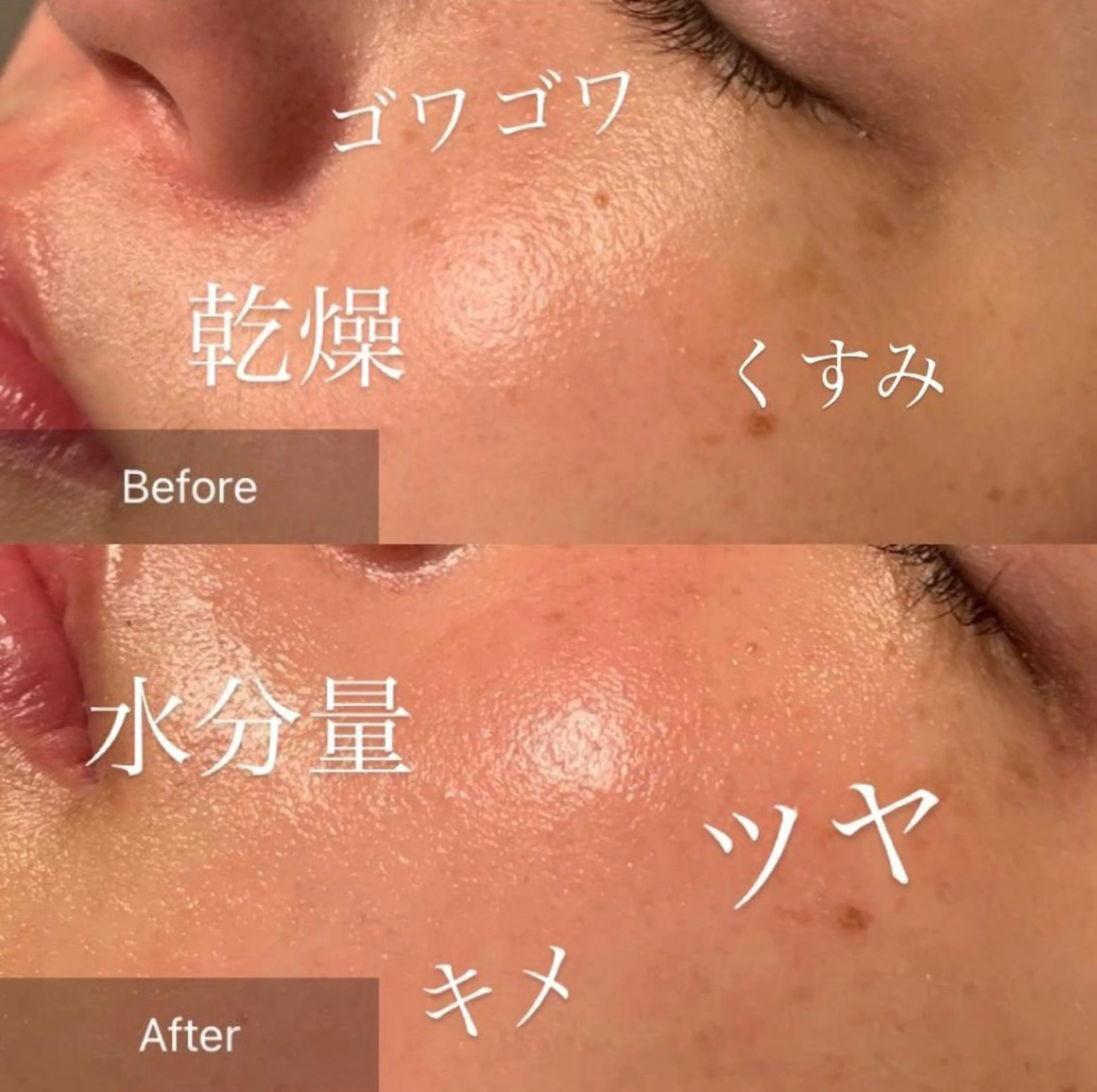 【ニキビケア🌈✨】ハーブピーリング✨🌿＋高濃度ビタミンC✨＋ラジオ派🔥✨¥13000 毛穴・シミ・ニキビ・ニキビ跡の写真