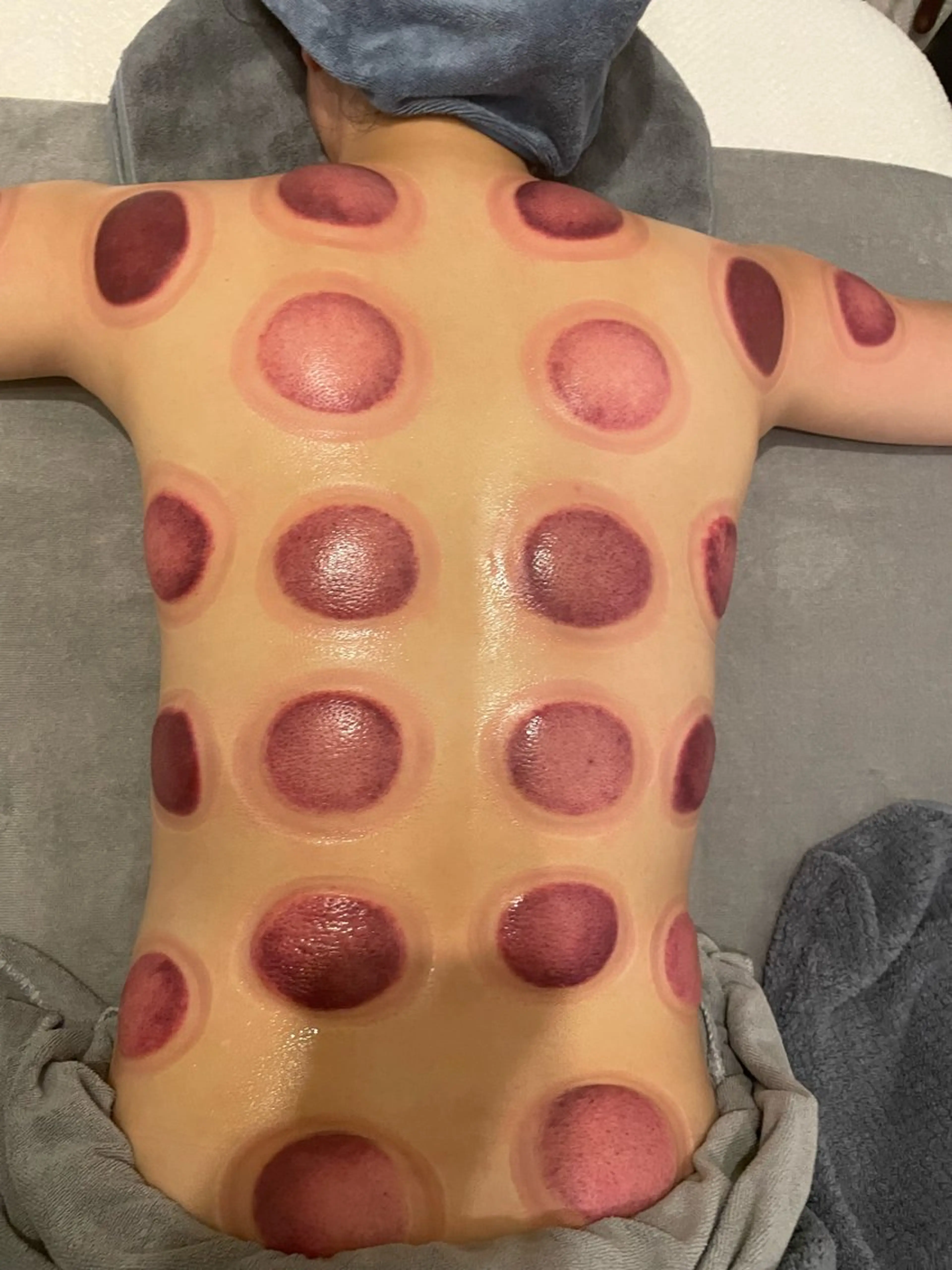 カッピング   30分の写真