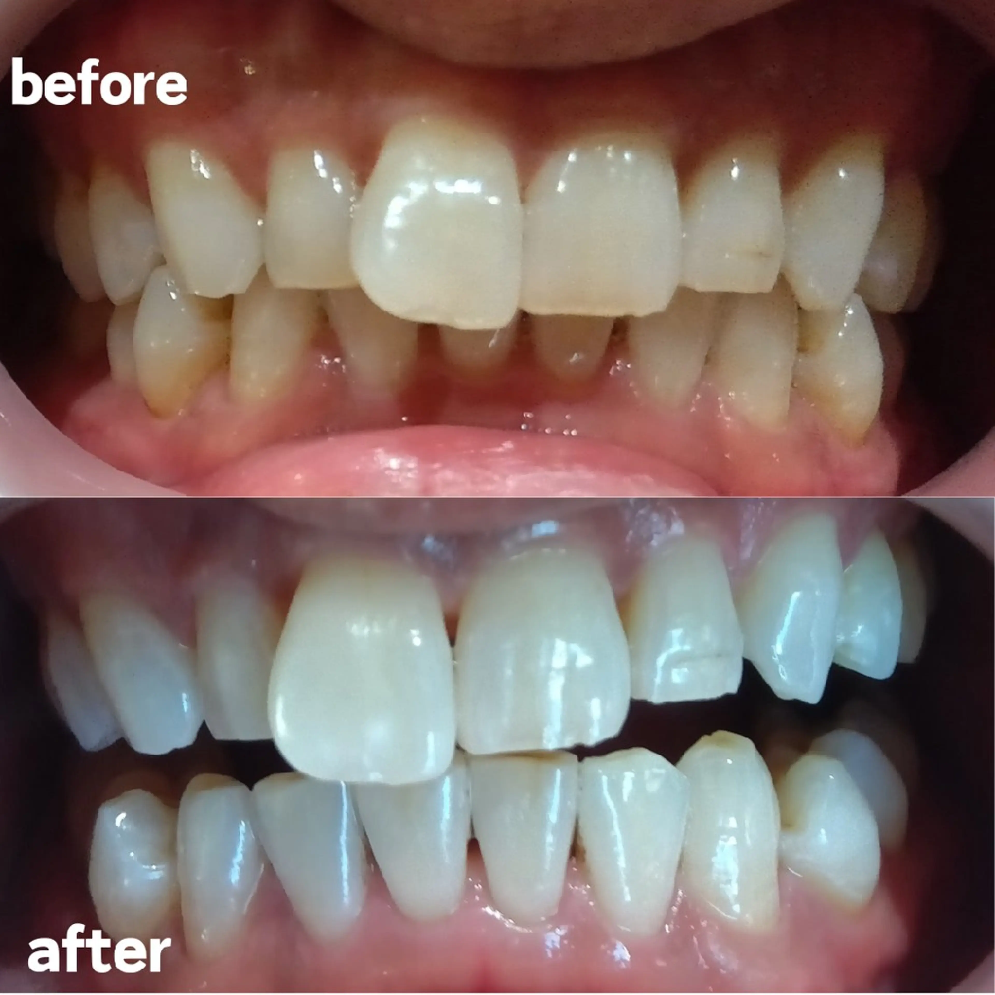 【ミニモ学割】15歳以上の学生セルフホワイトニング8分照射×2回の写真