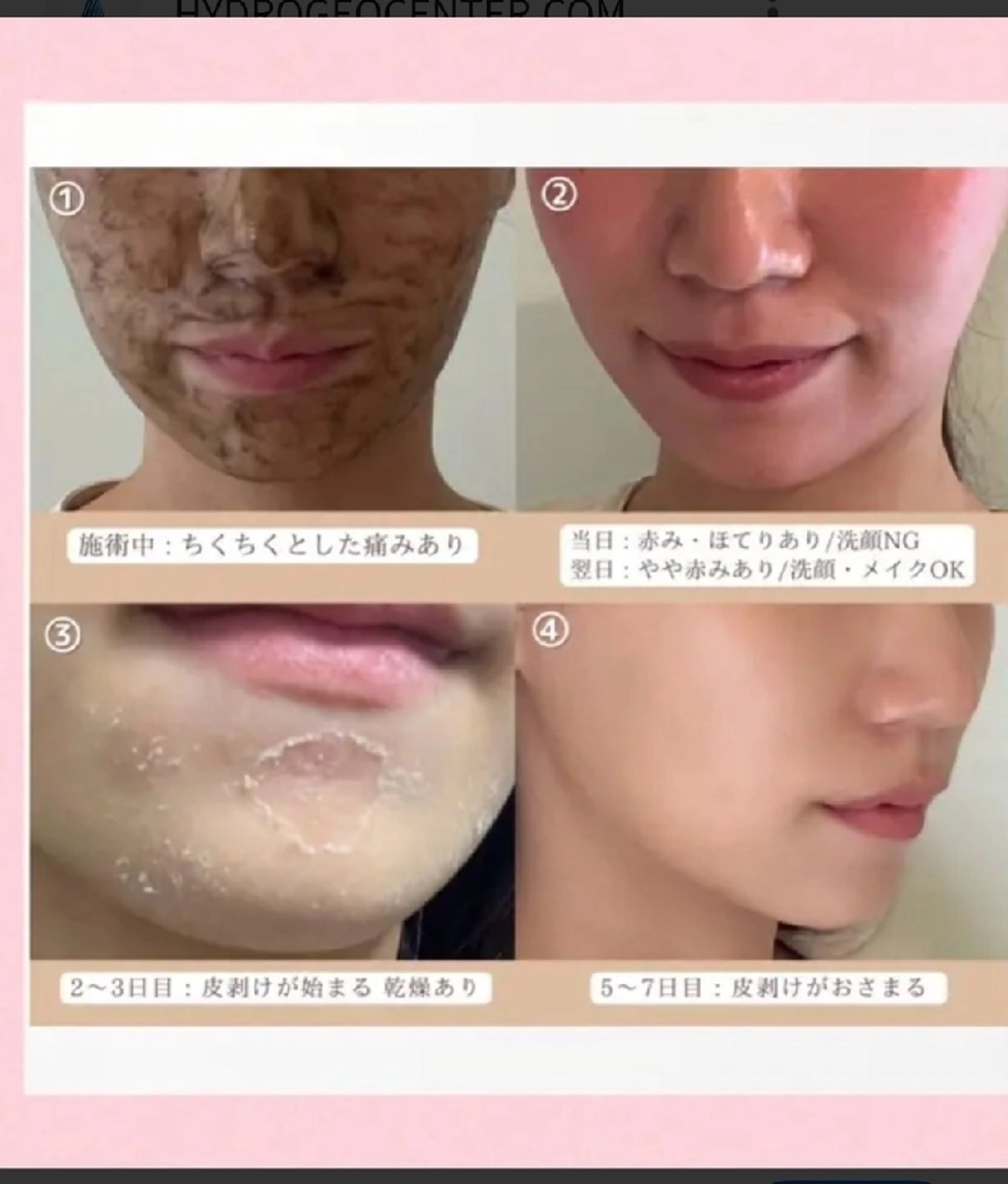 ハーブピーリング【剥離あり】+鎮静パック💐肌を根本から改善させる✨️ニキビ肌、キメに効果あり！の写真