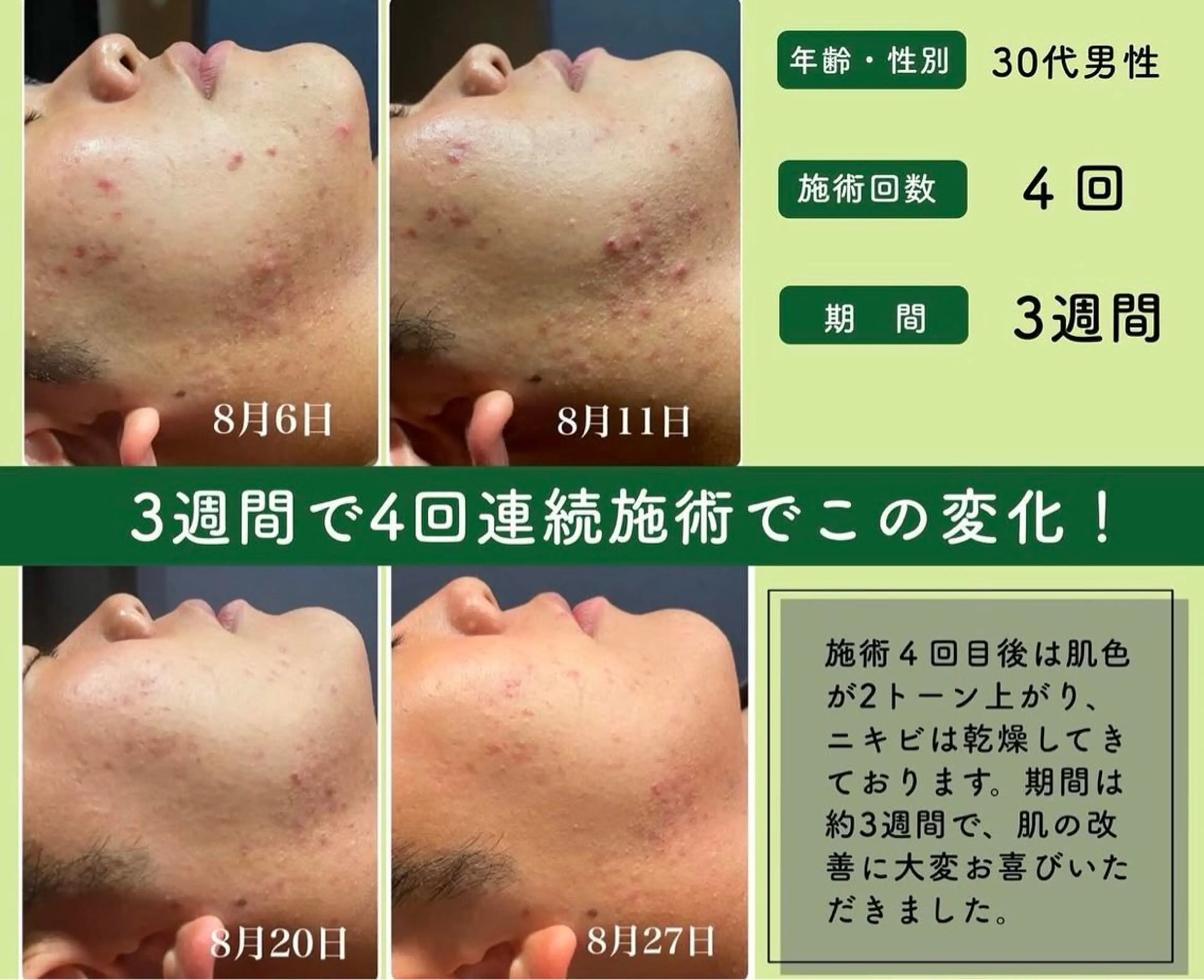 M.plus所属・水光韓国肌ハーブ ピーリングMplusのエステ・リラクイメージ