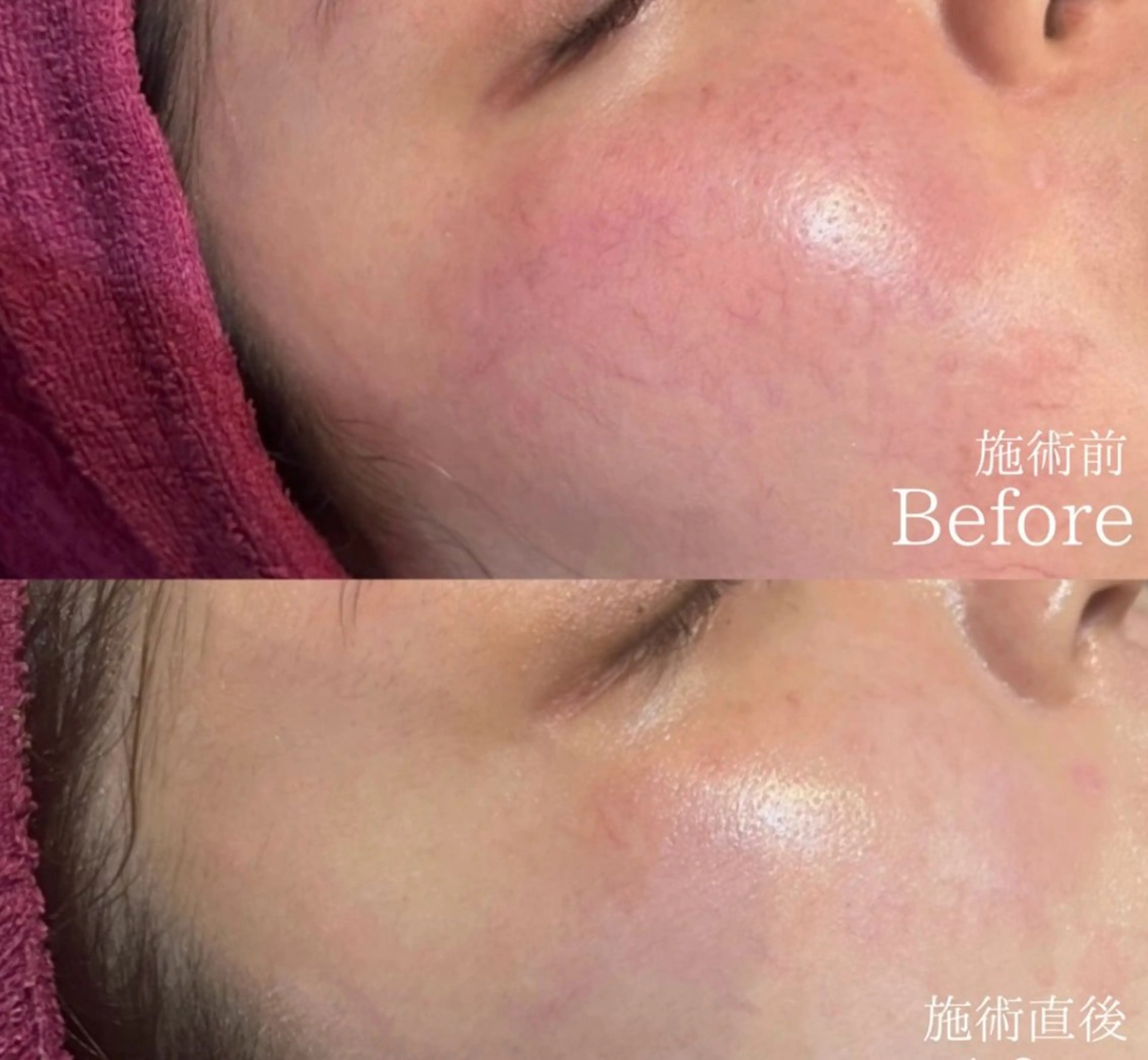 [半年後再来価格🉐] 剥離なしハーブピーリング🌿の写真