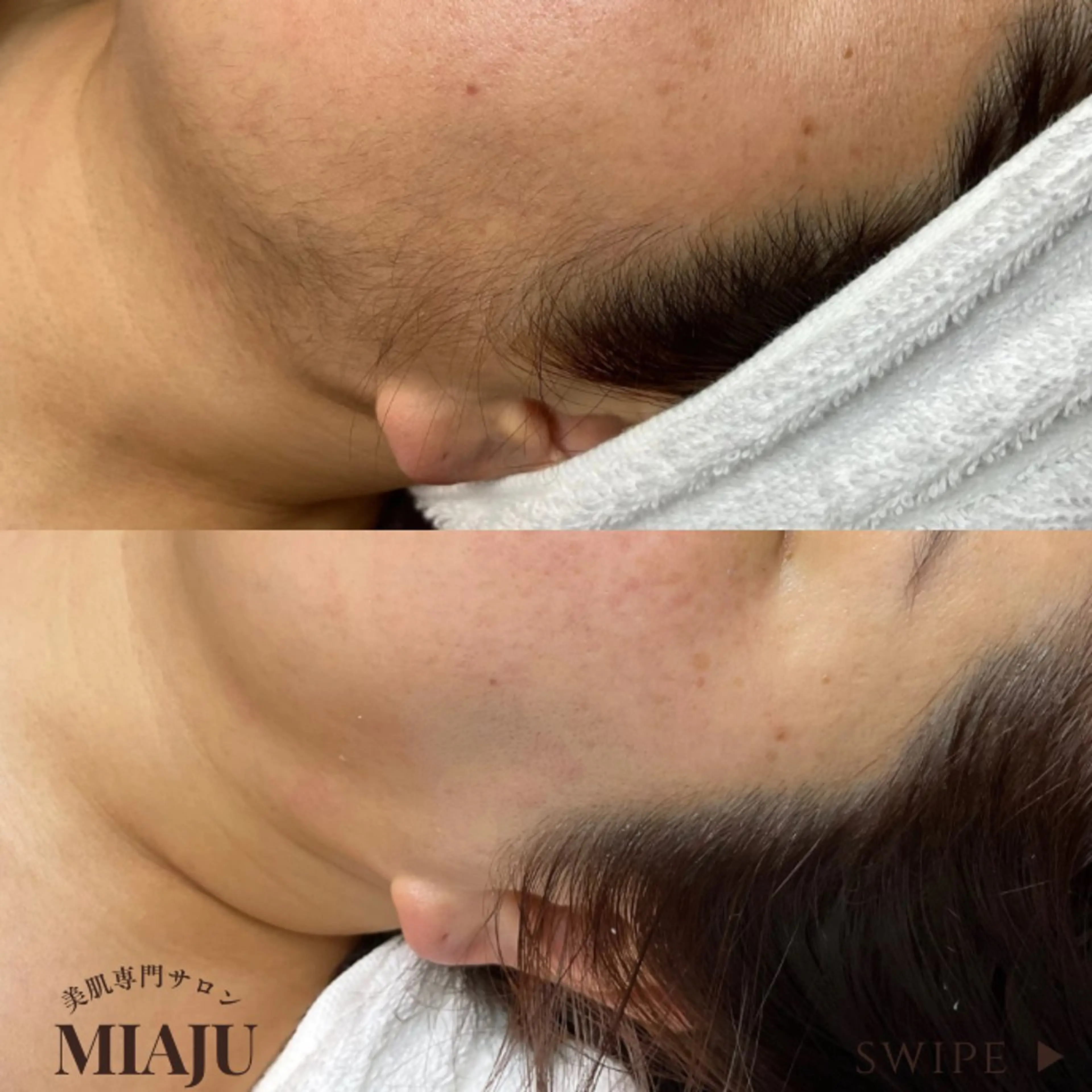 お顔のワックス脱毛+お仕上げの写真