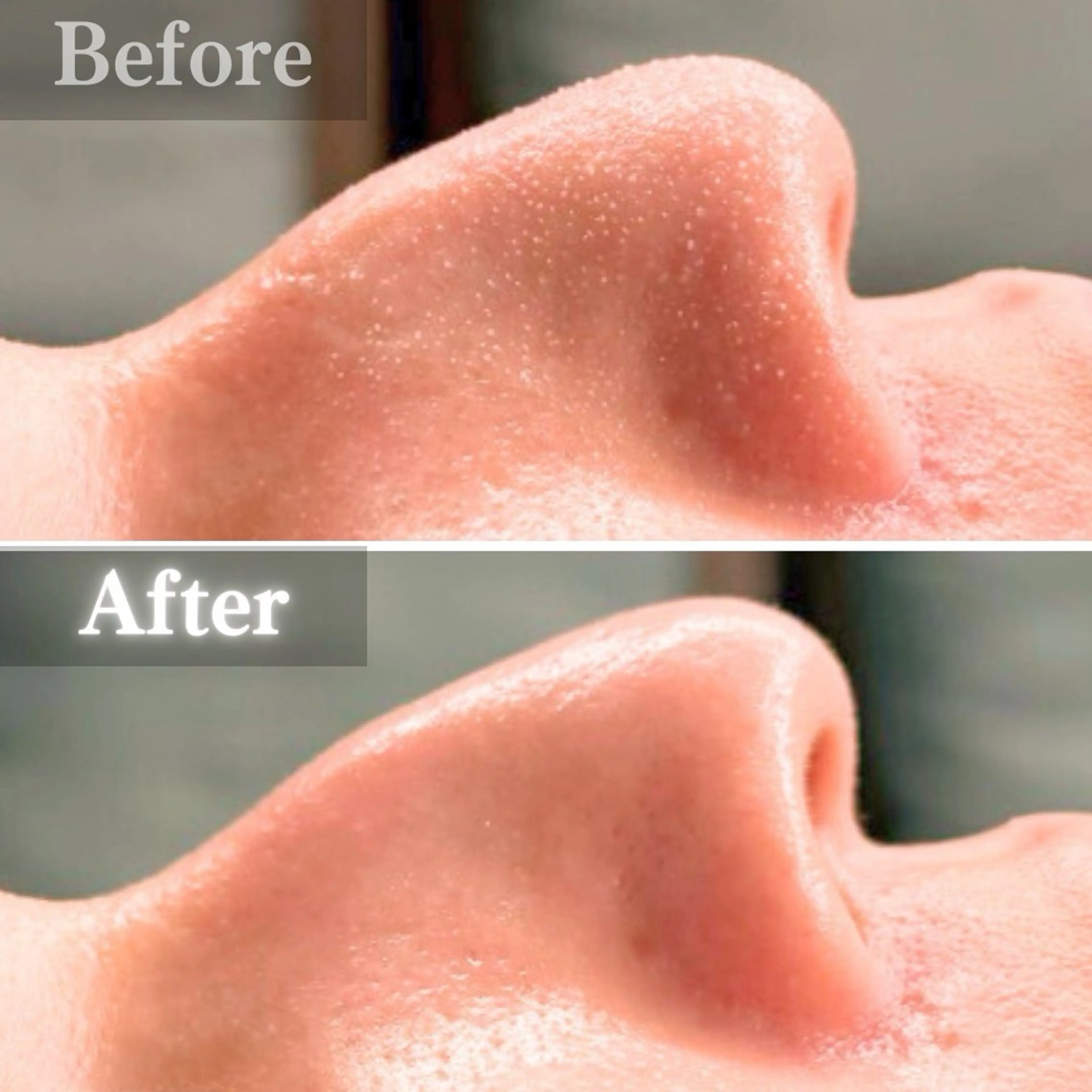 【角栓汚れゴッソリ!】毛穴洗浄(顔全体〜首)+エレクトロポレーション幹細胞美容液導入の写真