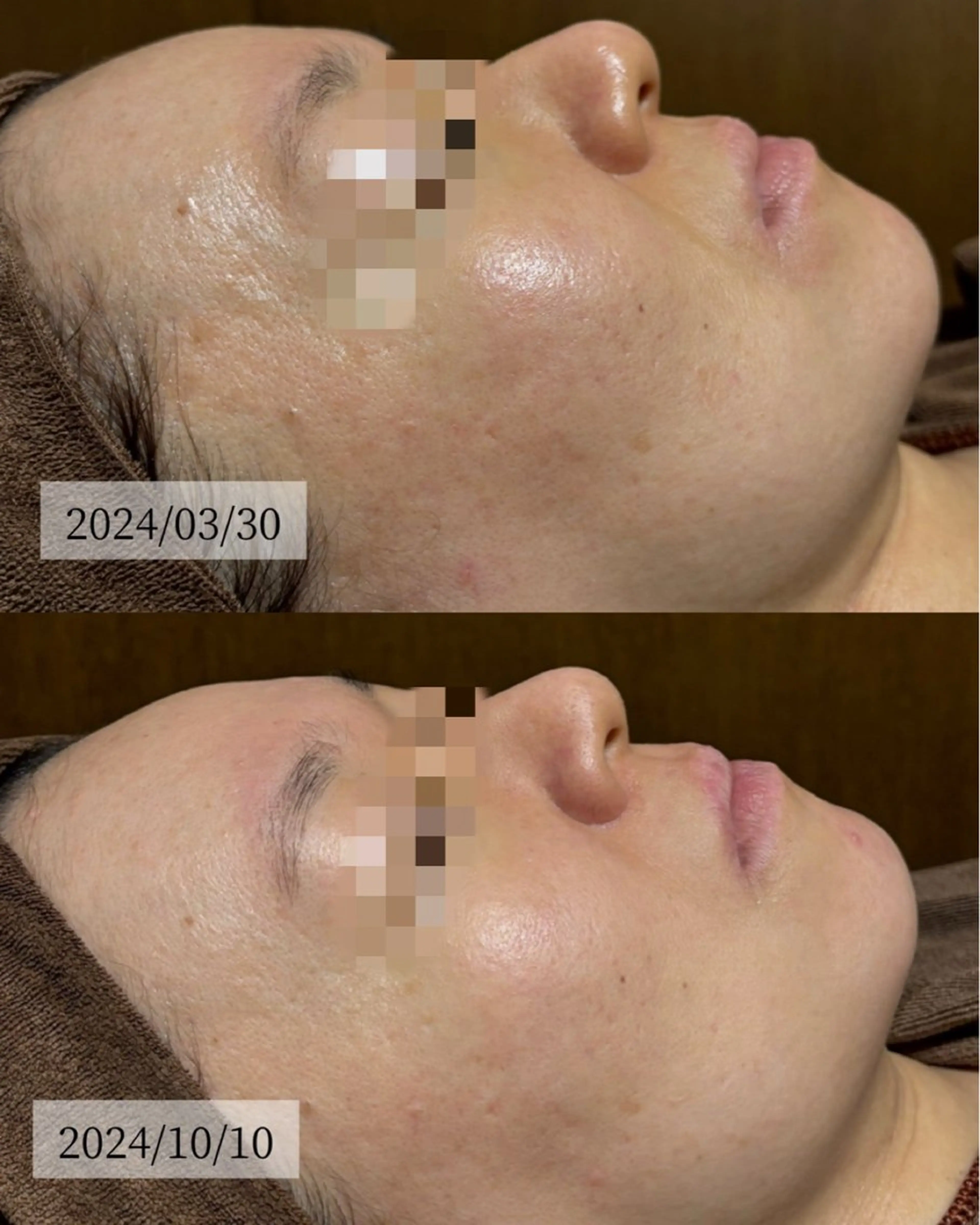 エステ HINANO矢場町店【ヒナノ】所属・脱毛/肌改善🌿 HINANO 村田のエステ・リラクイメージ