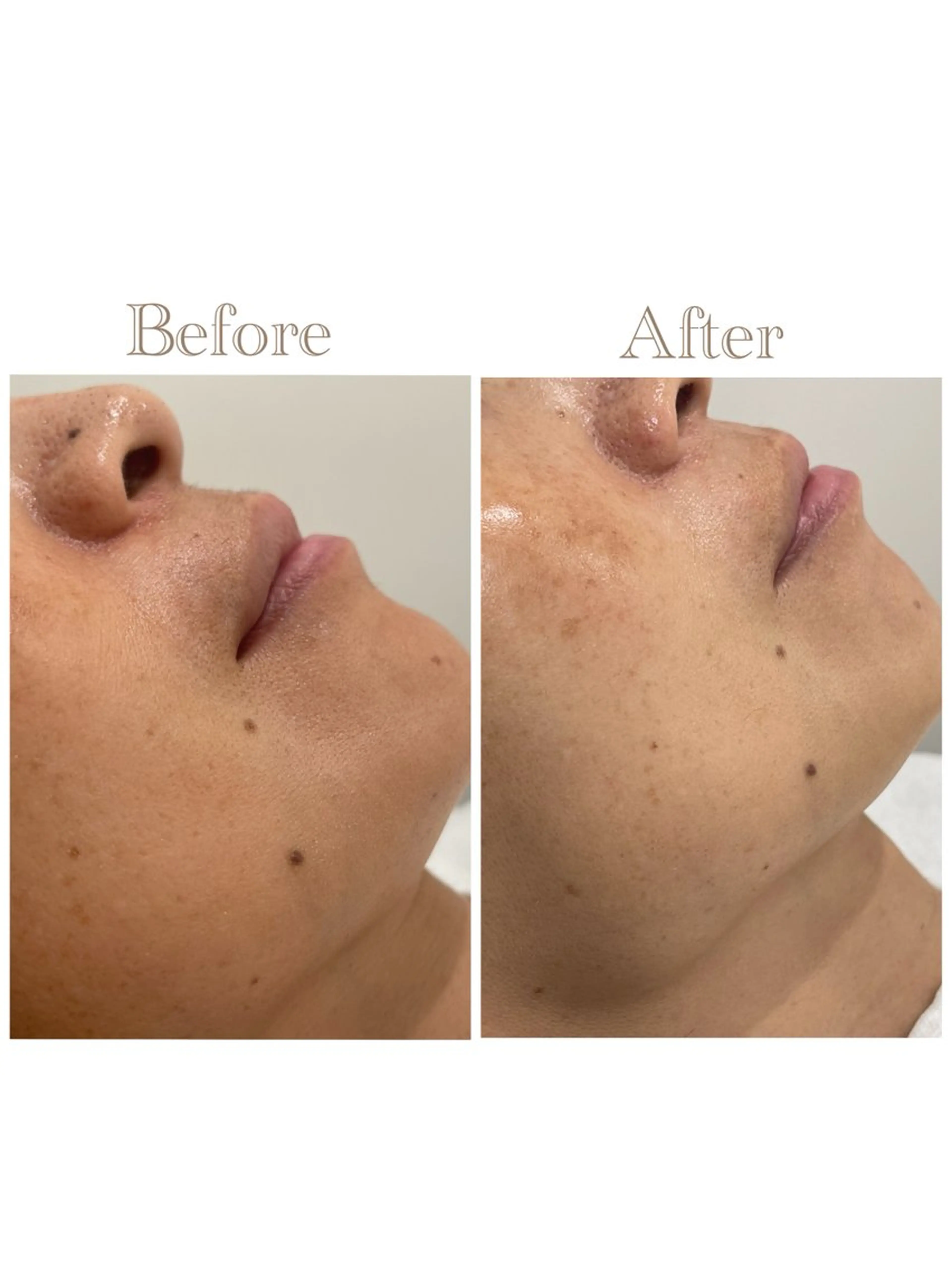 その他 お肌の角質ｹｱ / ﾍﾞﾗｽﾃｷﾞのその他イメージ