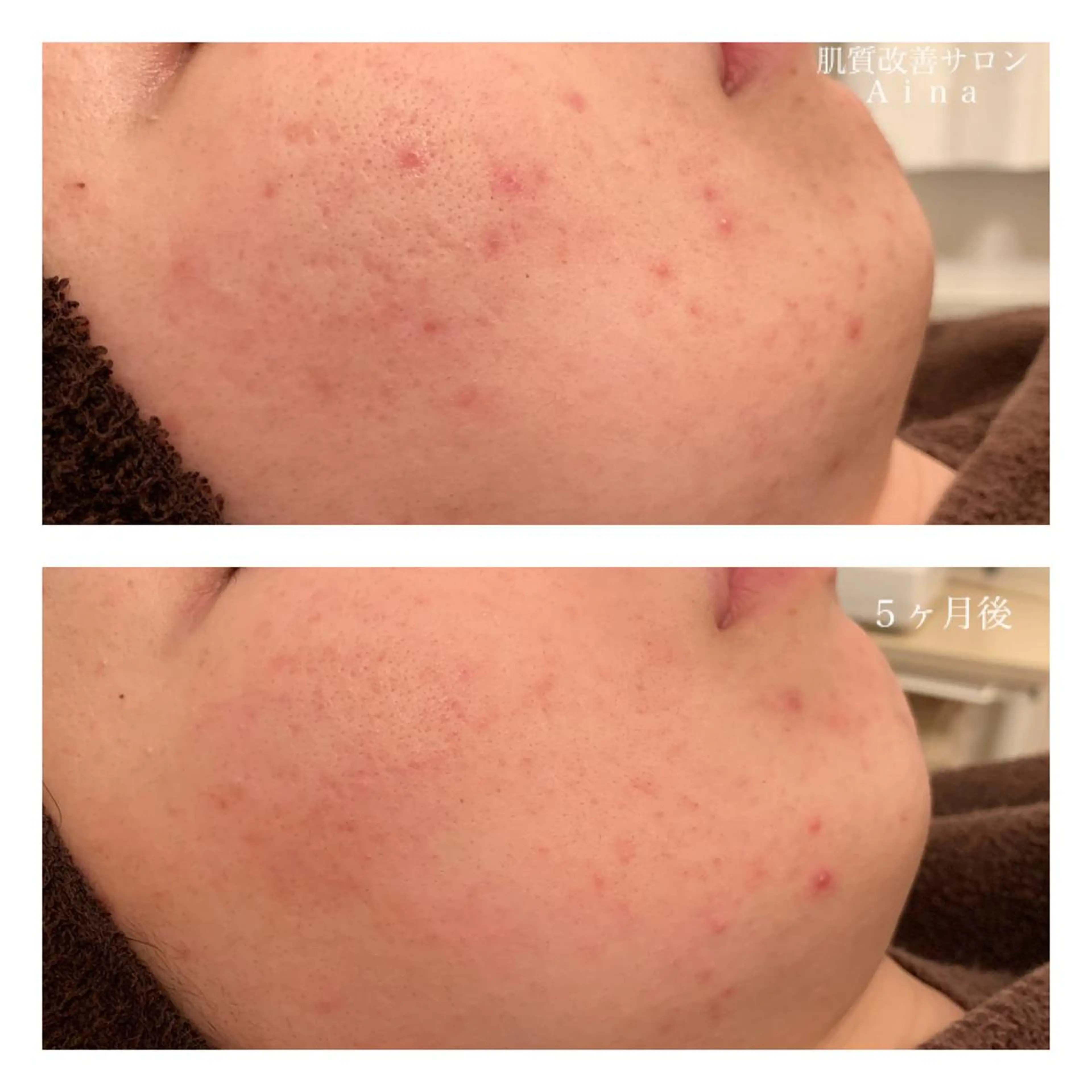 ミディアム カラー パーマ ヘアアレンジ メンズ キッズ ネイル マツエク・マツパ ニキビ跡専門サロン Ainaのエステ・リラクイメージ