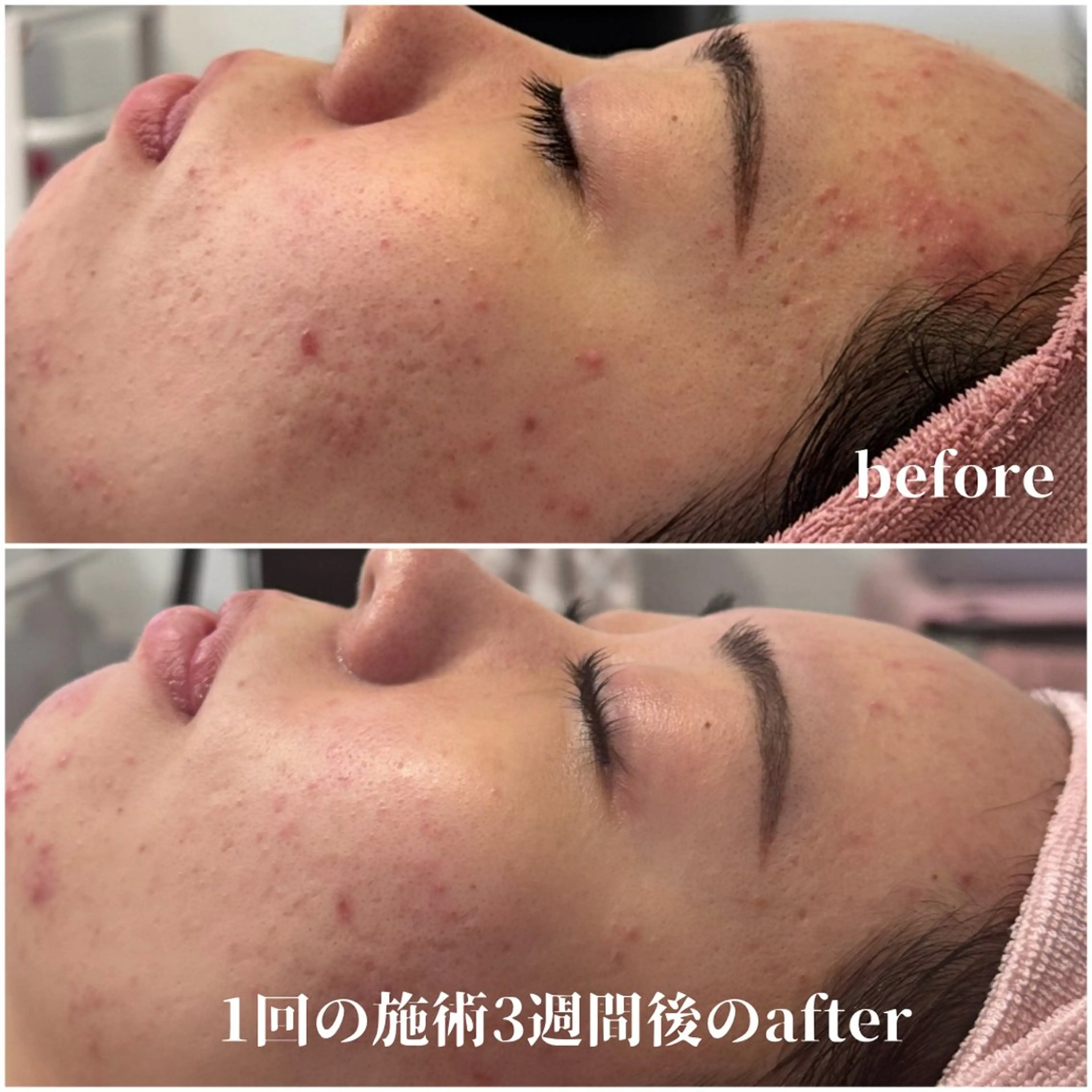 エステ 毛穴レス ハーブ＆ ワックス脱毛×光脱毛のエステ・リラクイメージ