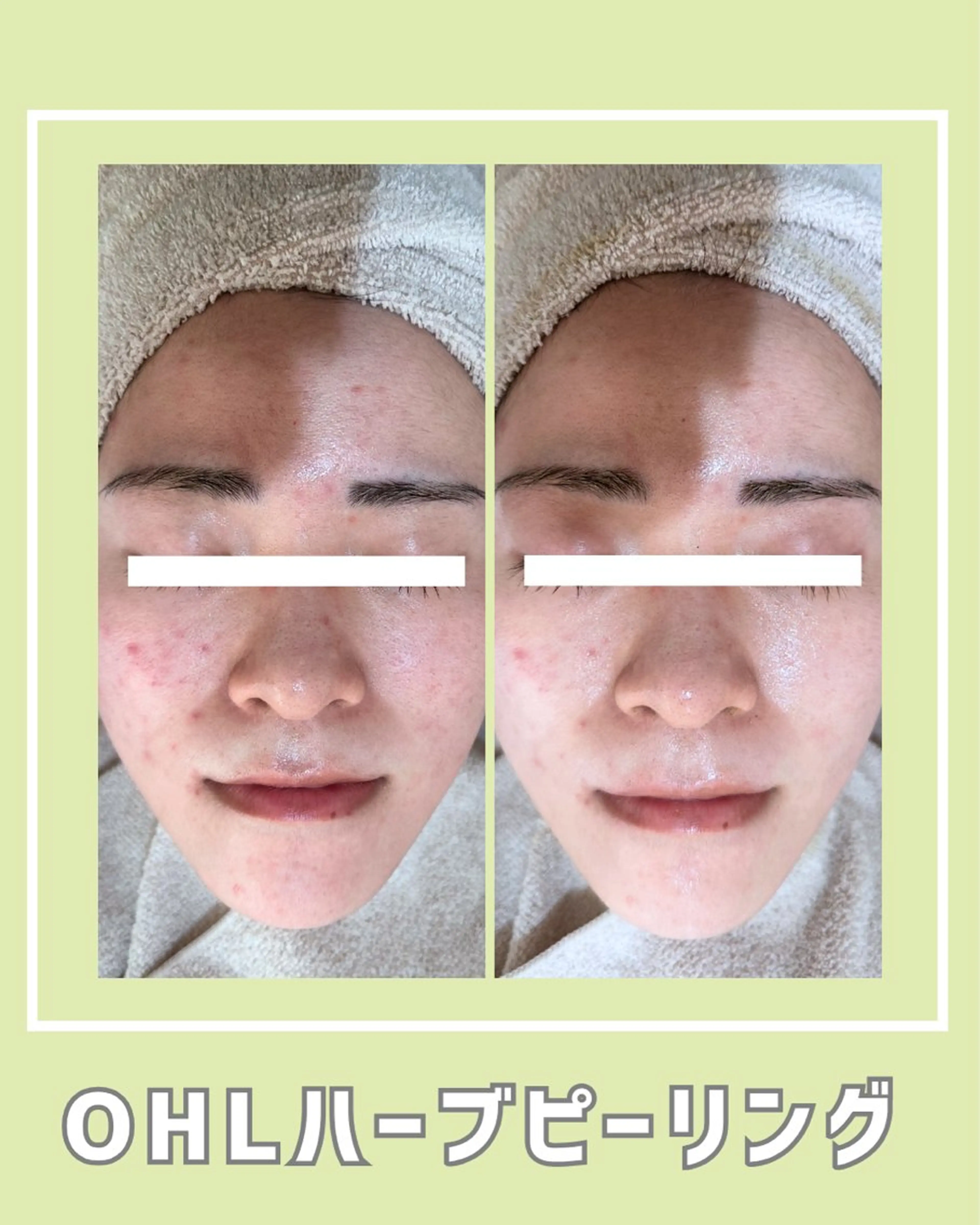 エステ |ピーリング・毛穴| soina神楽坂のエステ・リラクイメージ