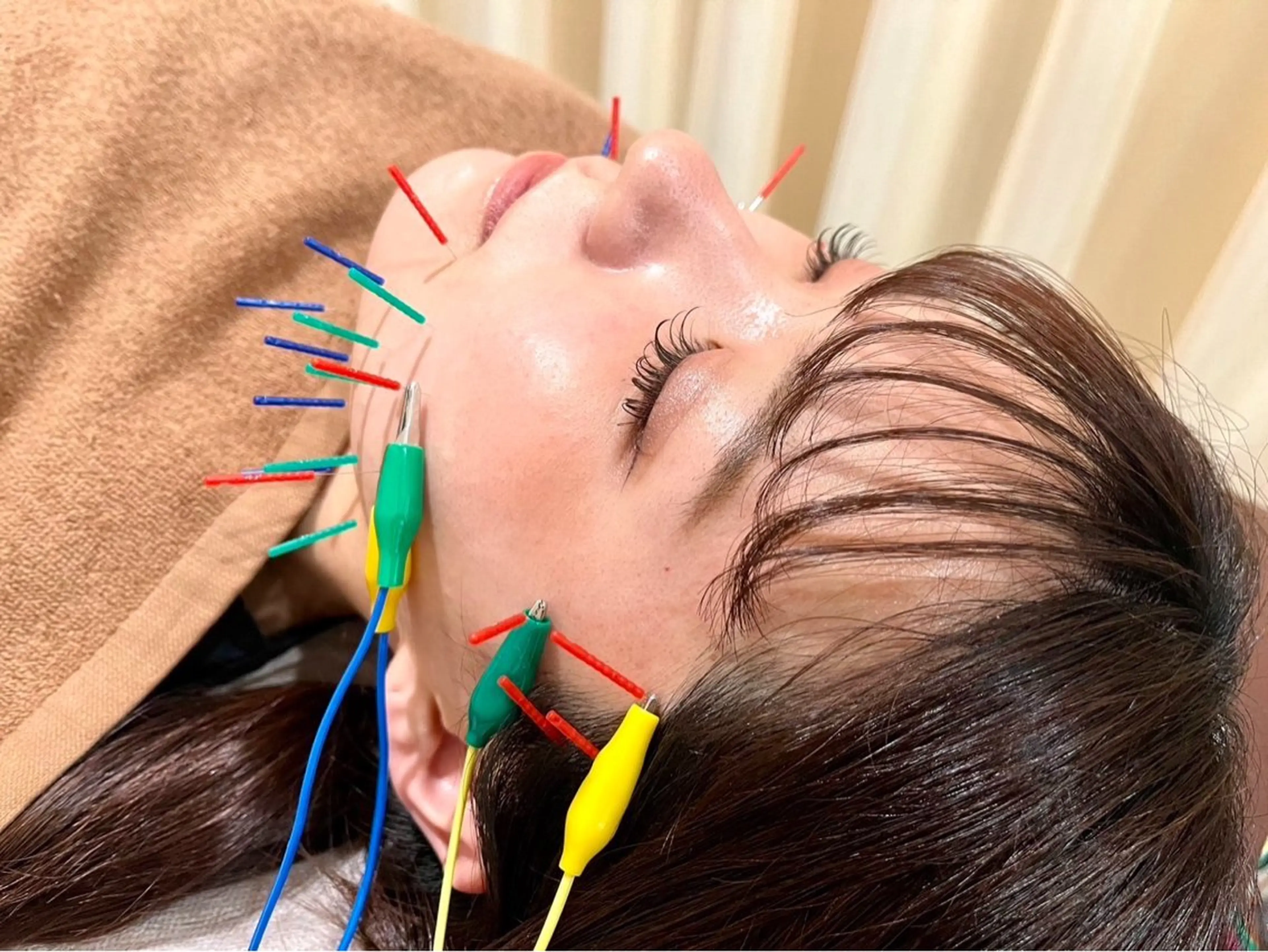 人気の【美容鍼】✨/むくみ/くすみ/食いしばり/頭皮のコリに✨30分施術のクイックコース❣️の写真