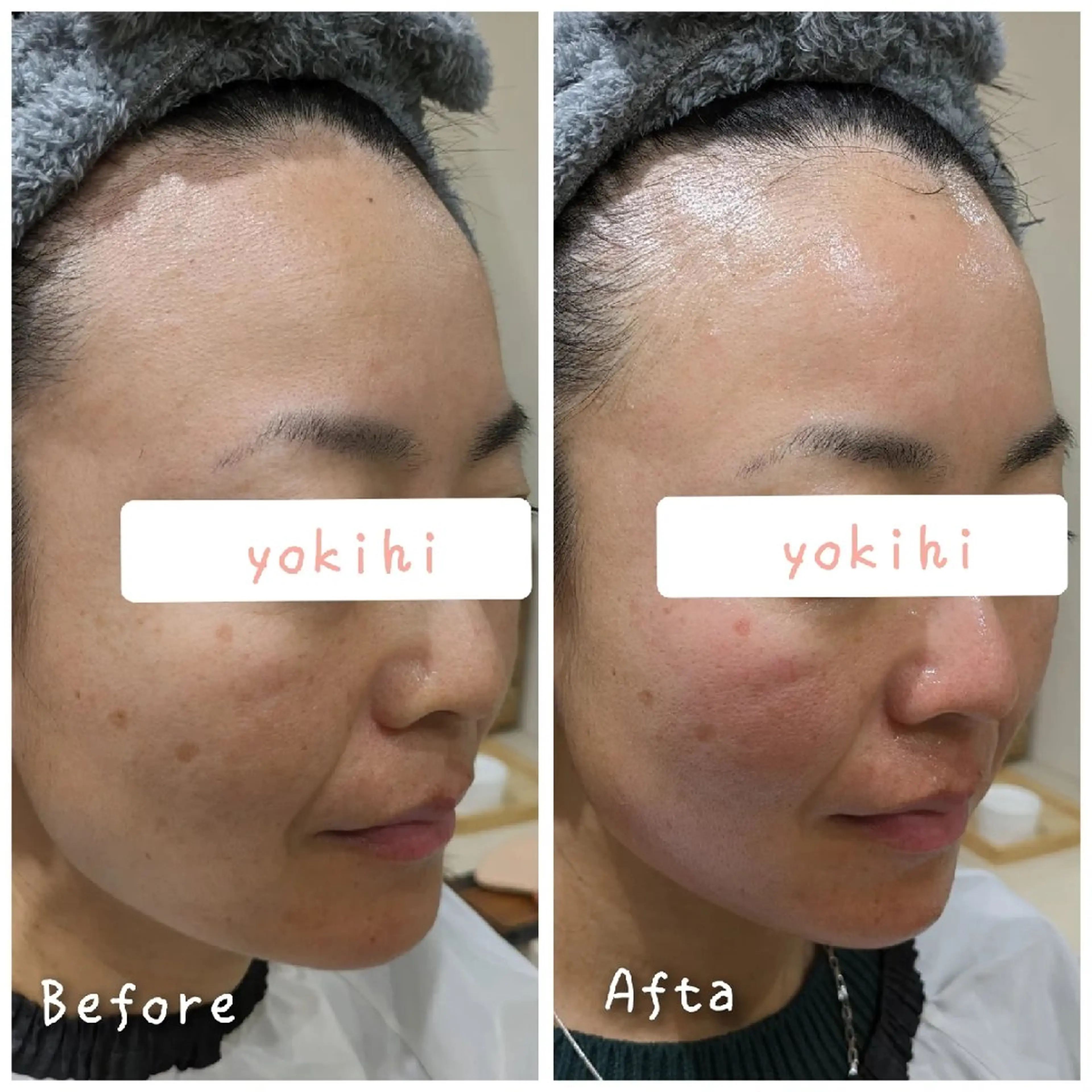 結果が出るスキンケア 肌質改善/まつパのエステ・リラクイメージ