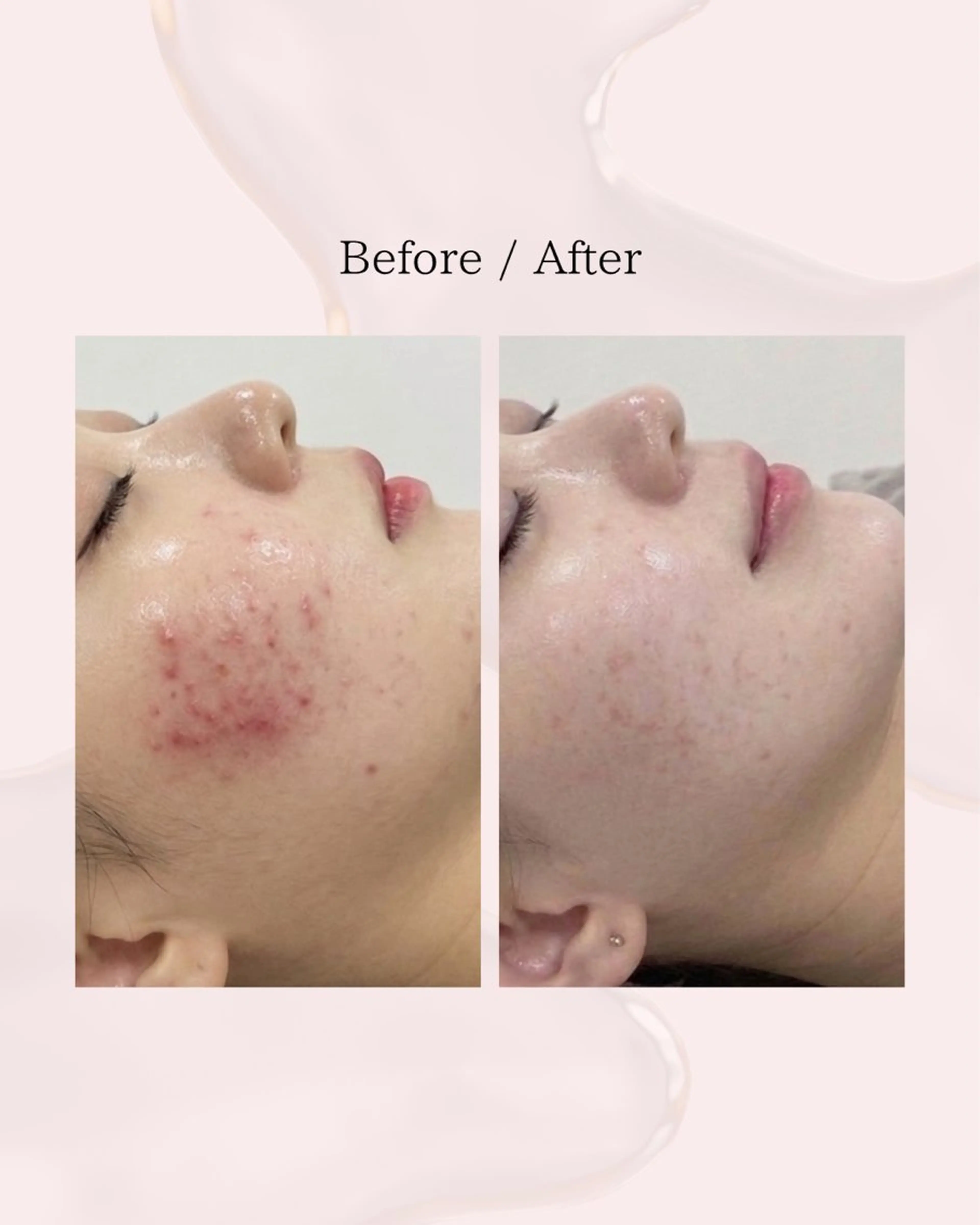 エステ myherb所属・ニキビ肌改善サロン myherb🌿のエステ・リラクイメージ