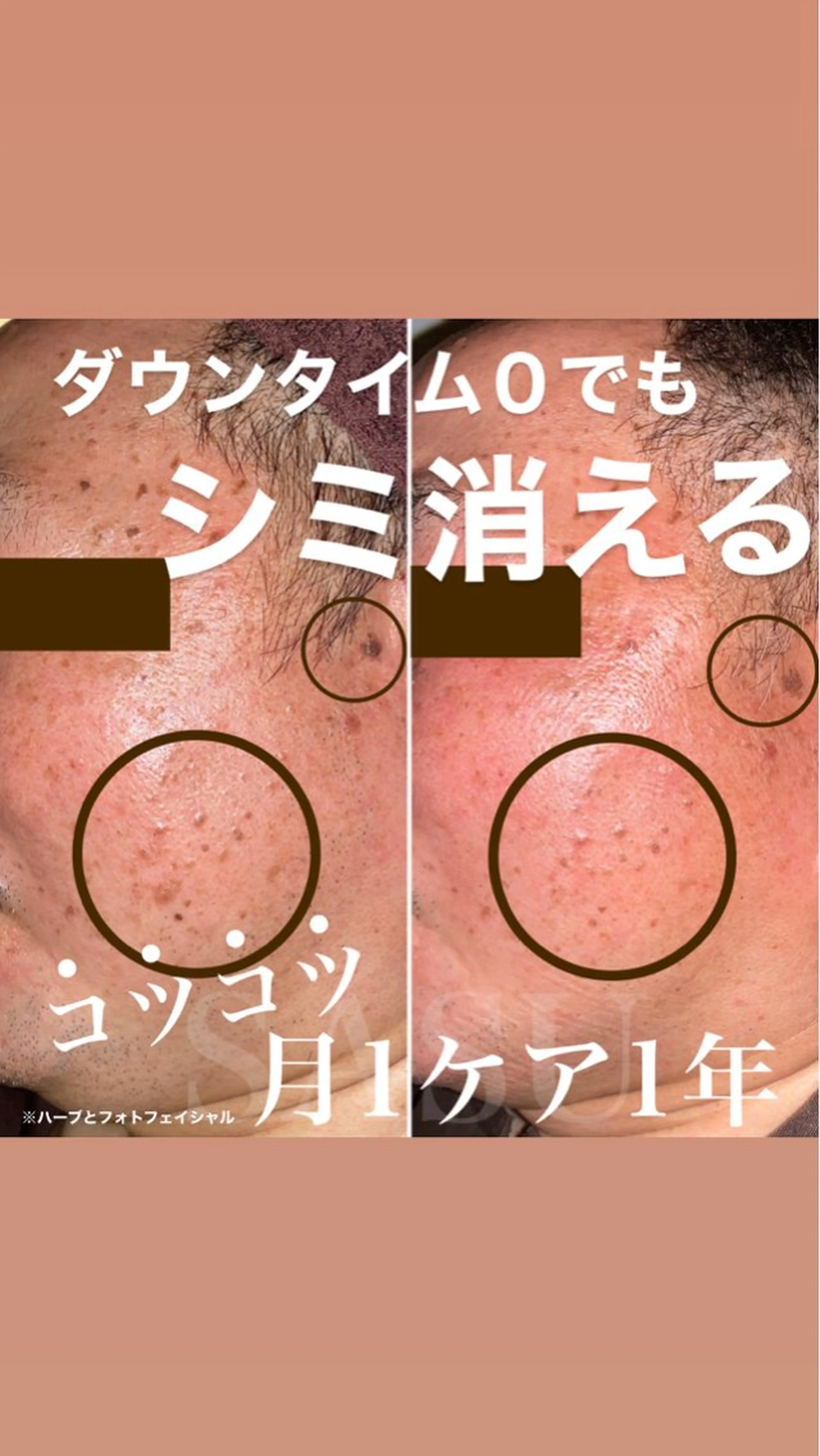 その他 鍼灸×ハーブピーリングサロンSASU所属・石井 稚乃のその他イメージ