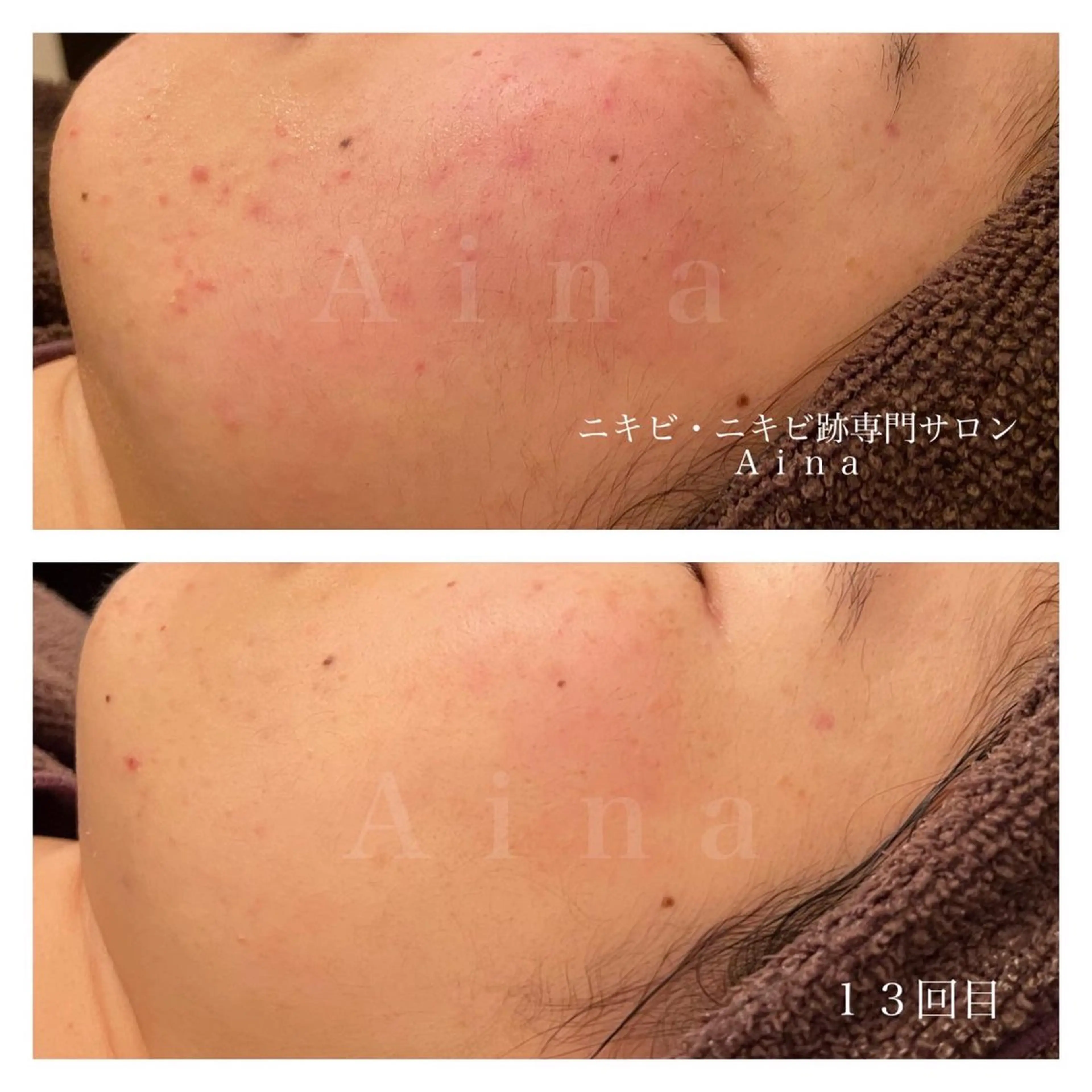 エステ リラク ニキビ跡専門サロン Ainaのエステ・リラクイメージ