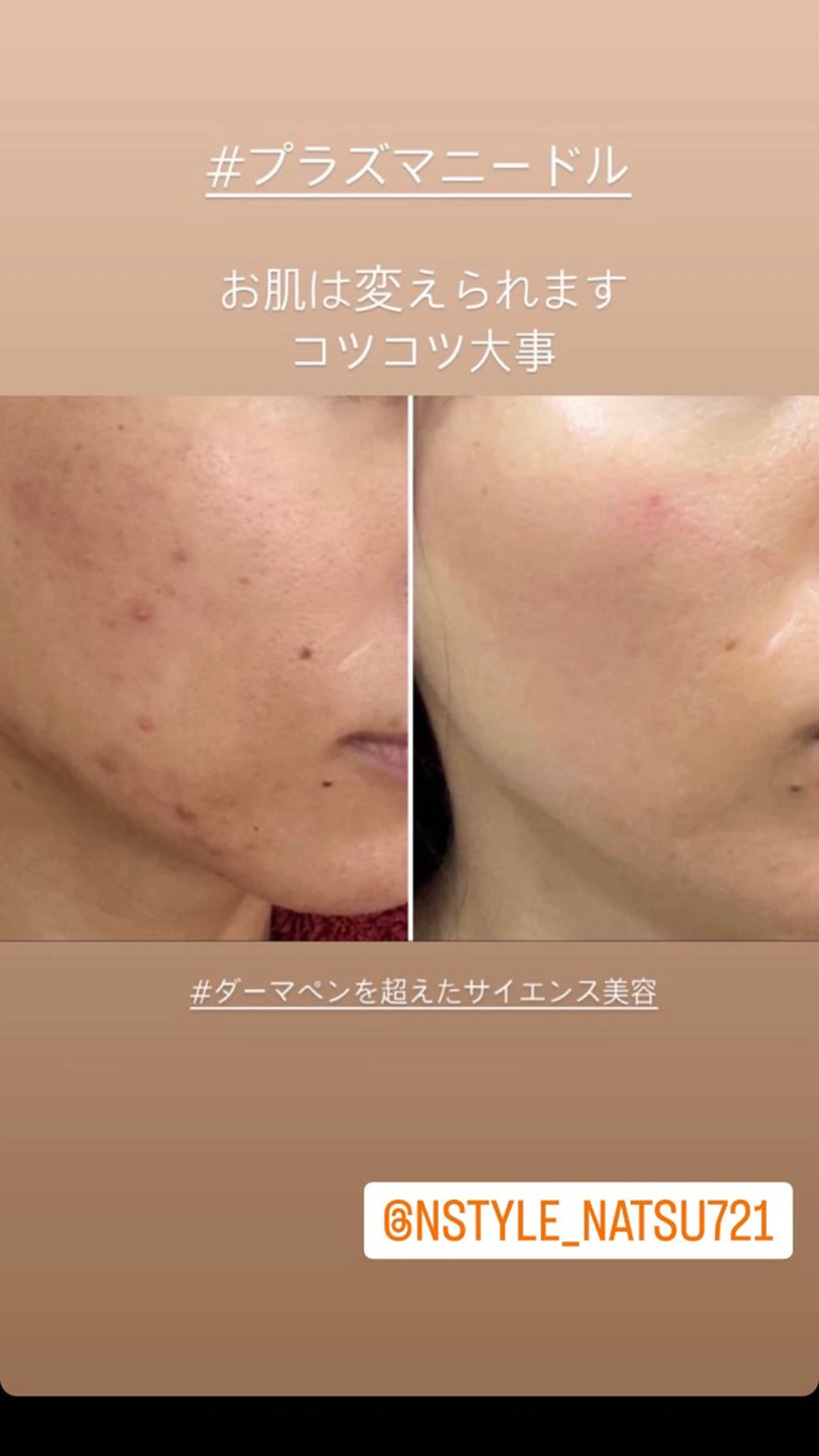 【凸凹肌でお悩みの方必見!!】ダーマを超えるサイエンス美容のプラズマがNO.1🫶ニキビ跡・シミ・くすみにも◎の写真