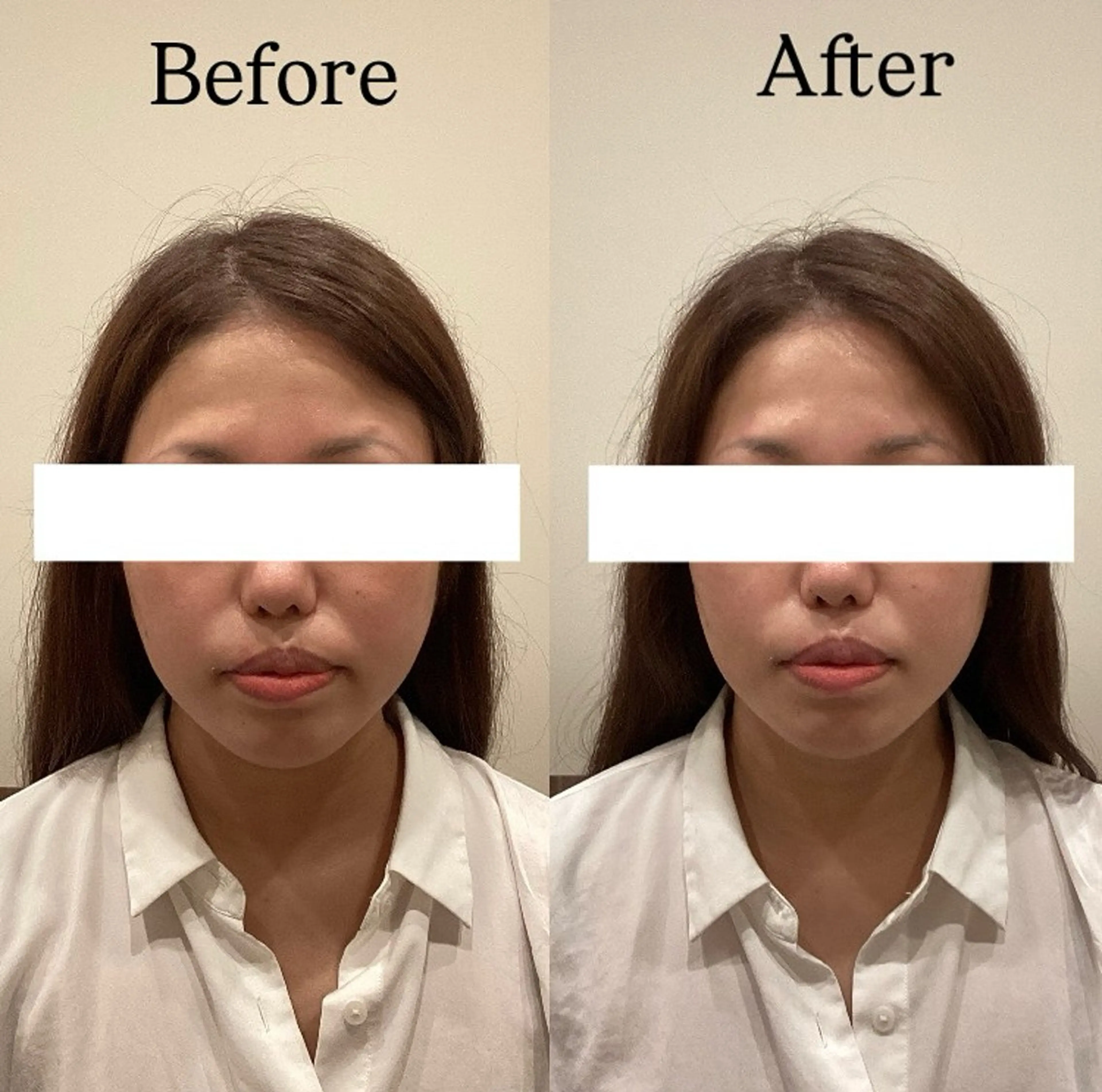 💘special美容鍼(80本)💫の写真