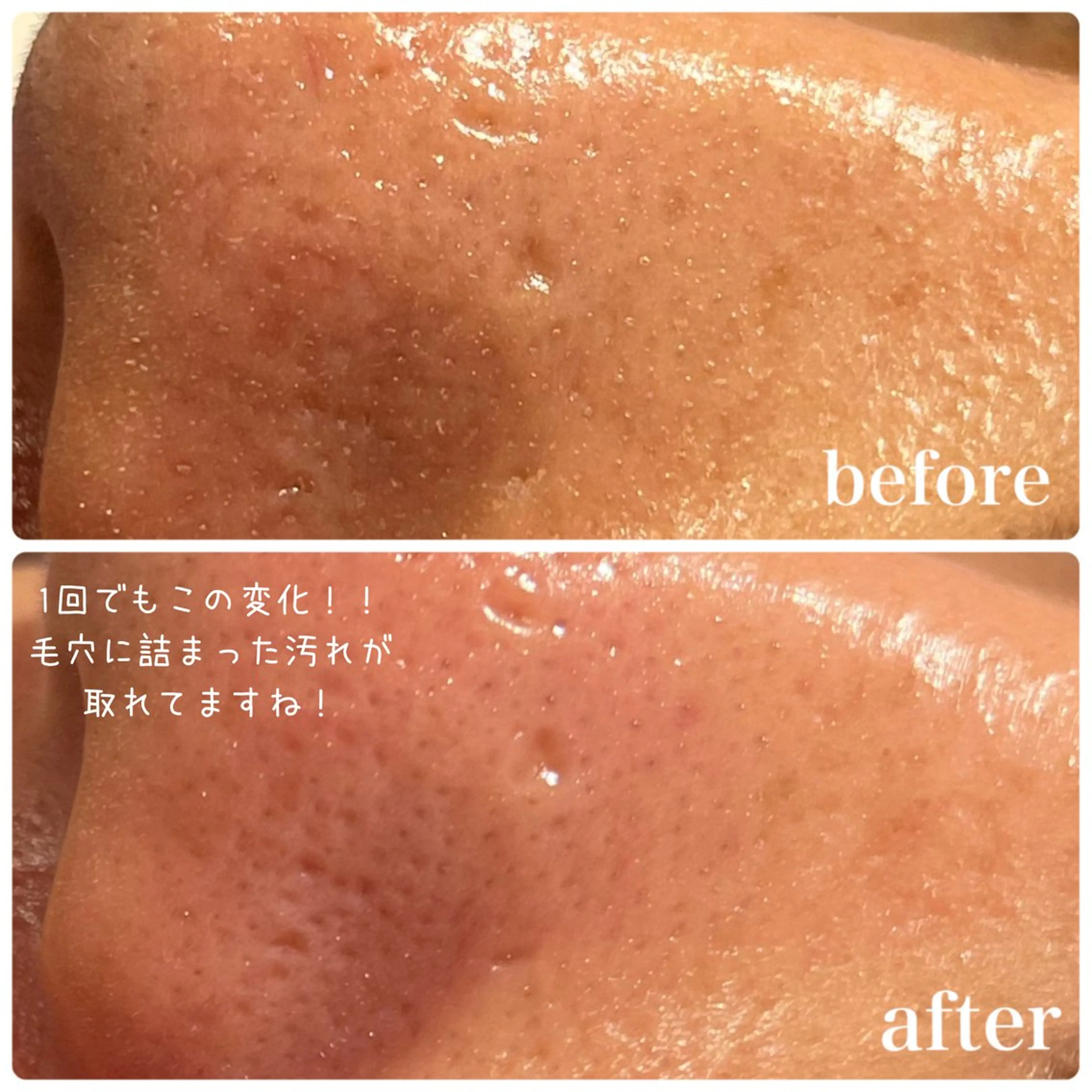 【口コミ価格】ハイドラフェイシャル(毛穴洗浄)×管理栄養士による食事カウンセリング付の写真