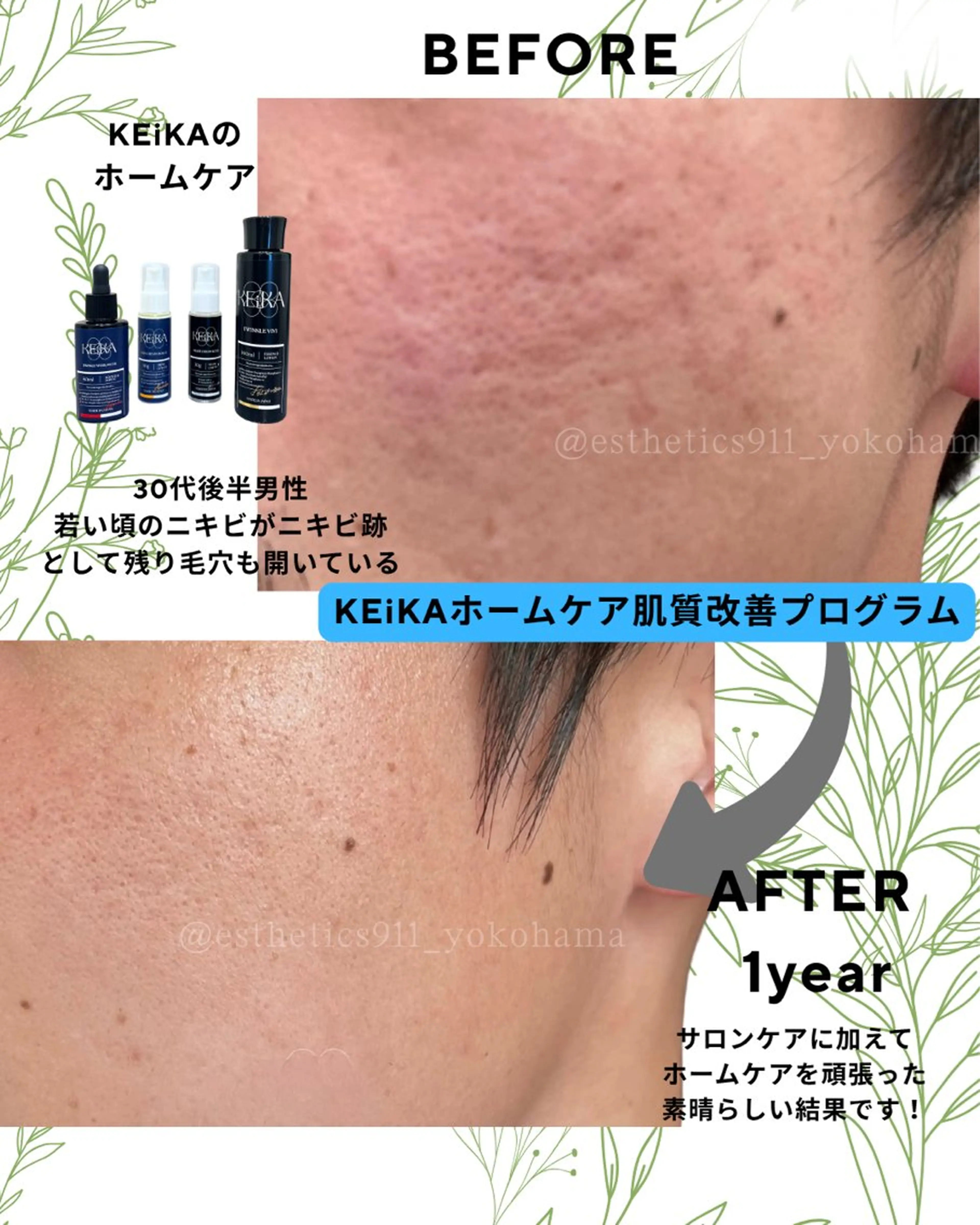 【メンズ！お昼限定】シミニキビ跡乾燥肌に悩む★イケオジになる！老け顔対策★Wアプローチ！フェイシャルエステコース初回の写真