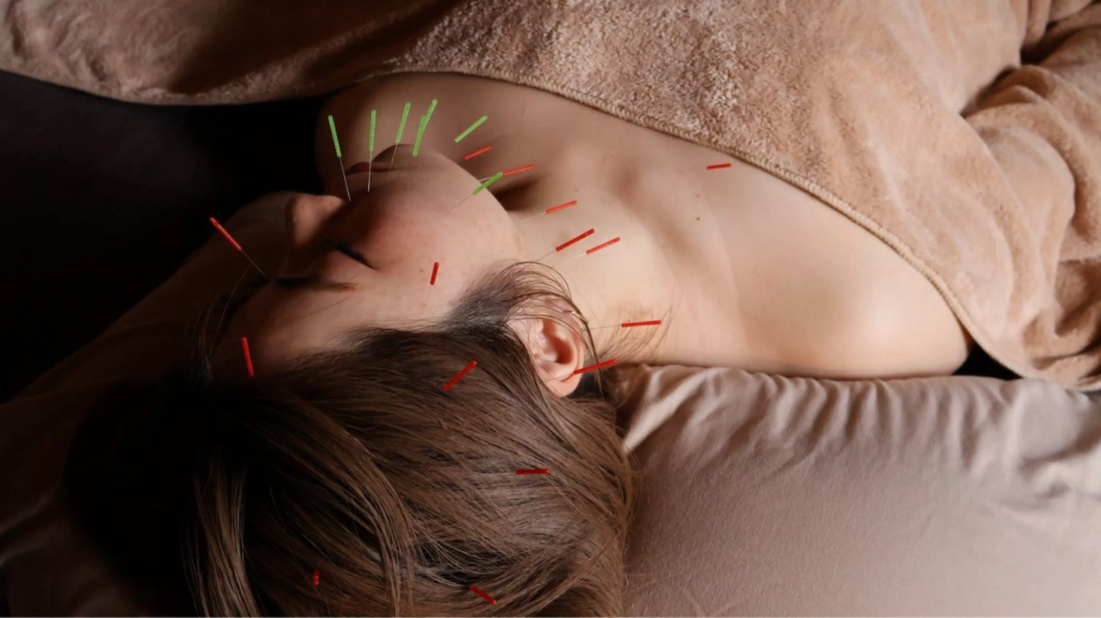 ¥11,000→¥6,000初回限定🎁小顔美容鍼＊首調整コース💎【支払い方法:現金のみとなっております】の写真