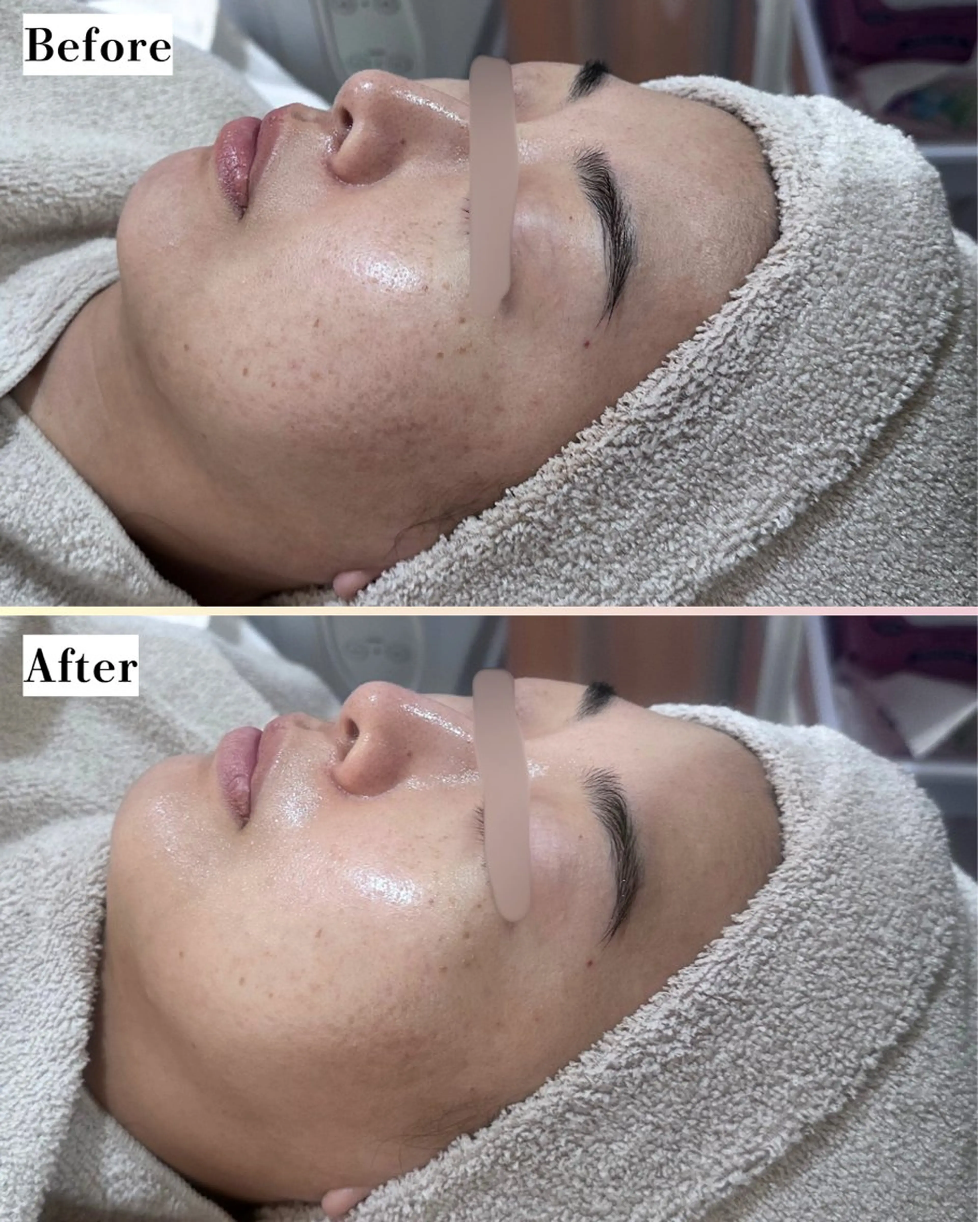 エステ |ピーリング・毛穴| soina神楽坂のエステ・リラクイメージ