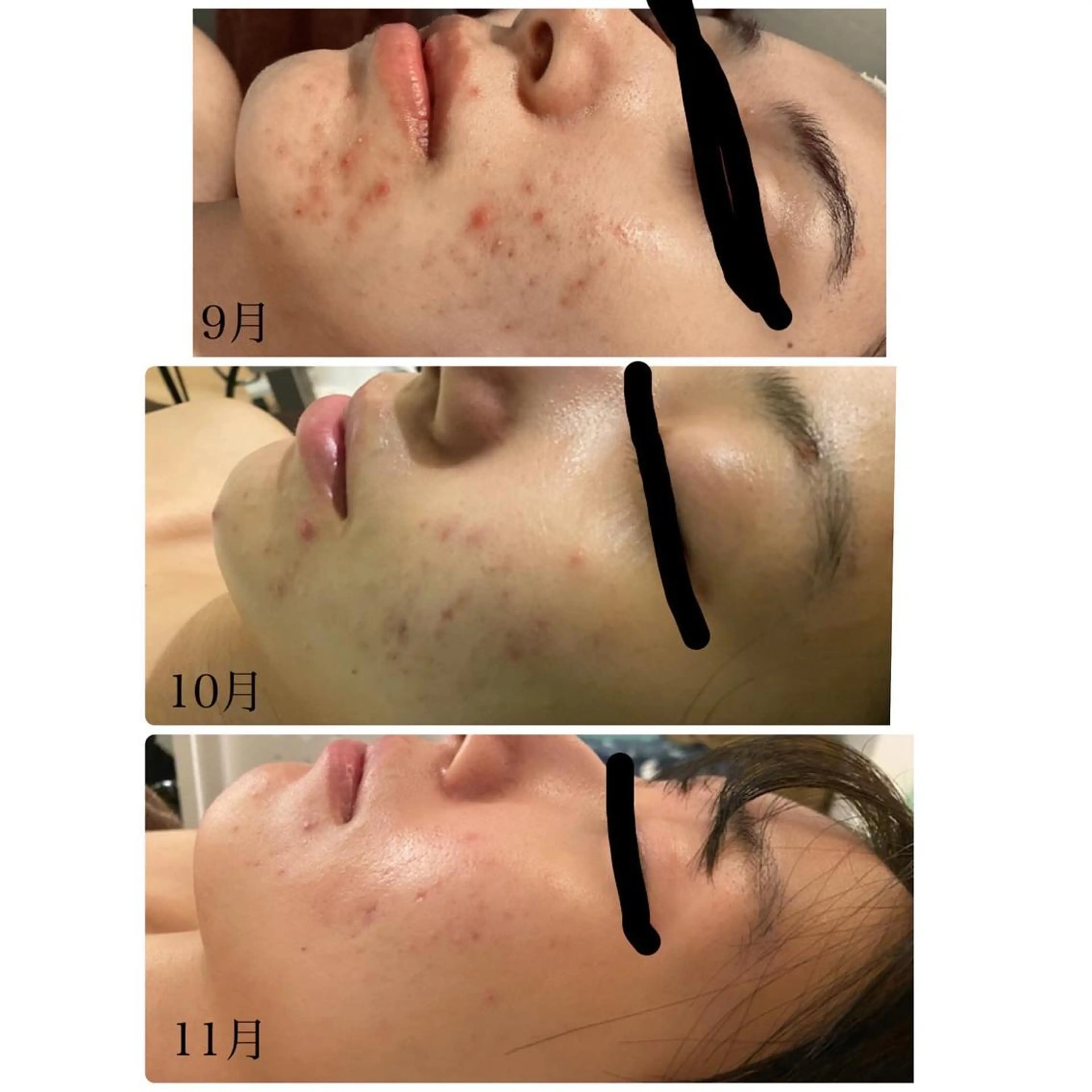 剥離あり🌿本格肌改善ハーブリプロ。凹凸肌、クレーター肌、ニキビ後、繰り返すシミ、、お肌表面トラブルを自身肌へ導きます！の写真