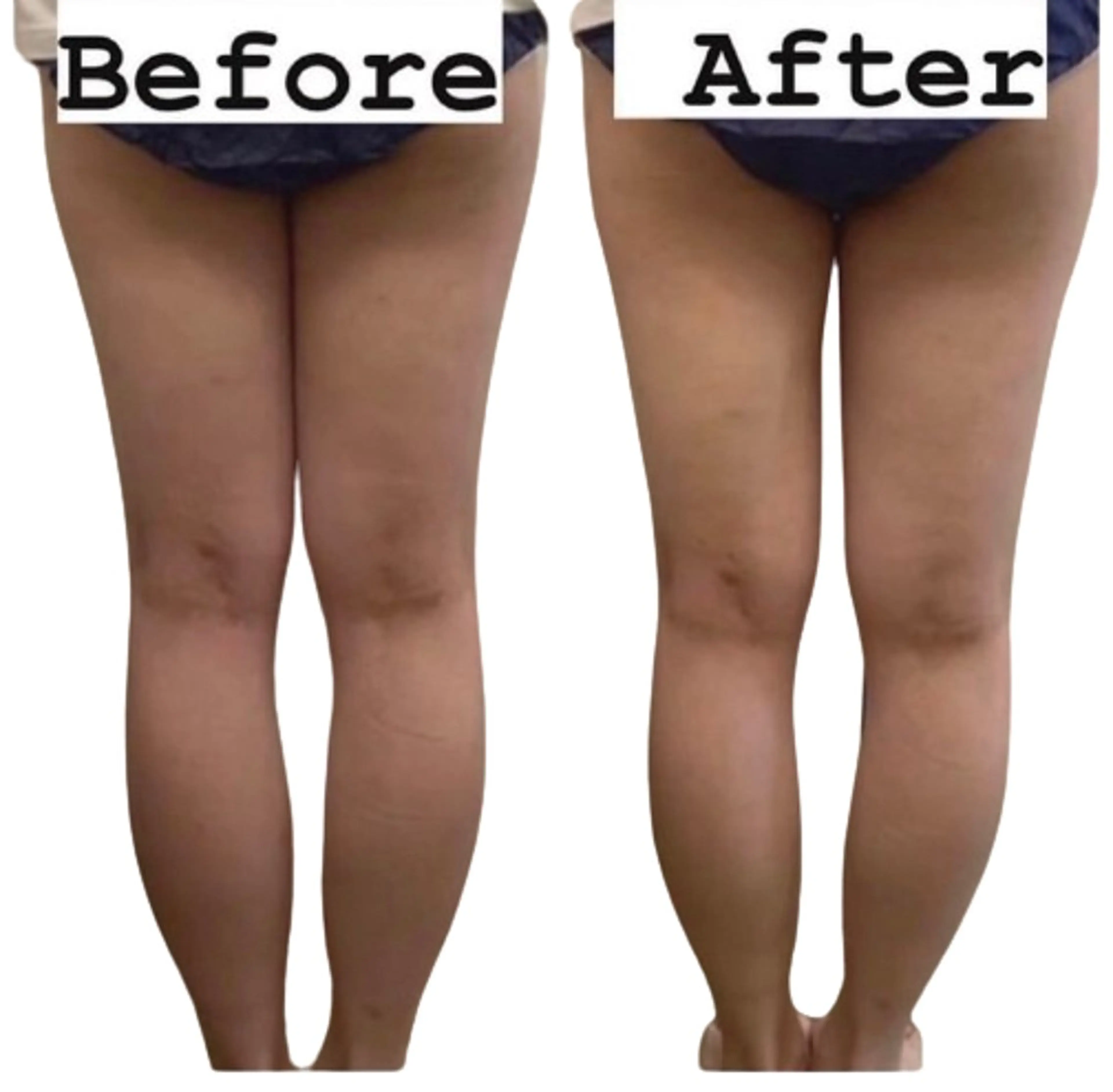 冷凍痩身20カップの写真