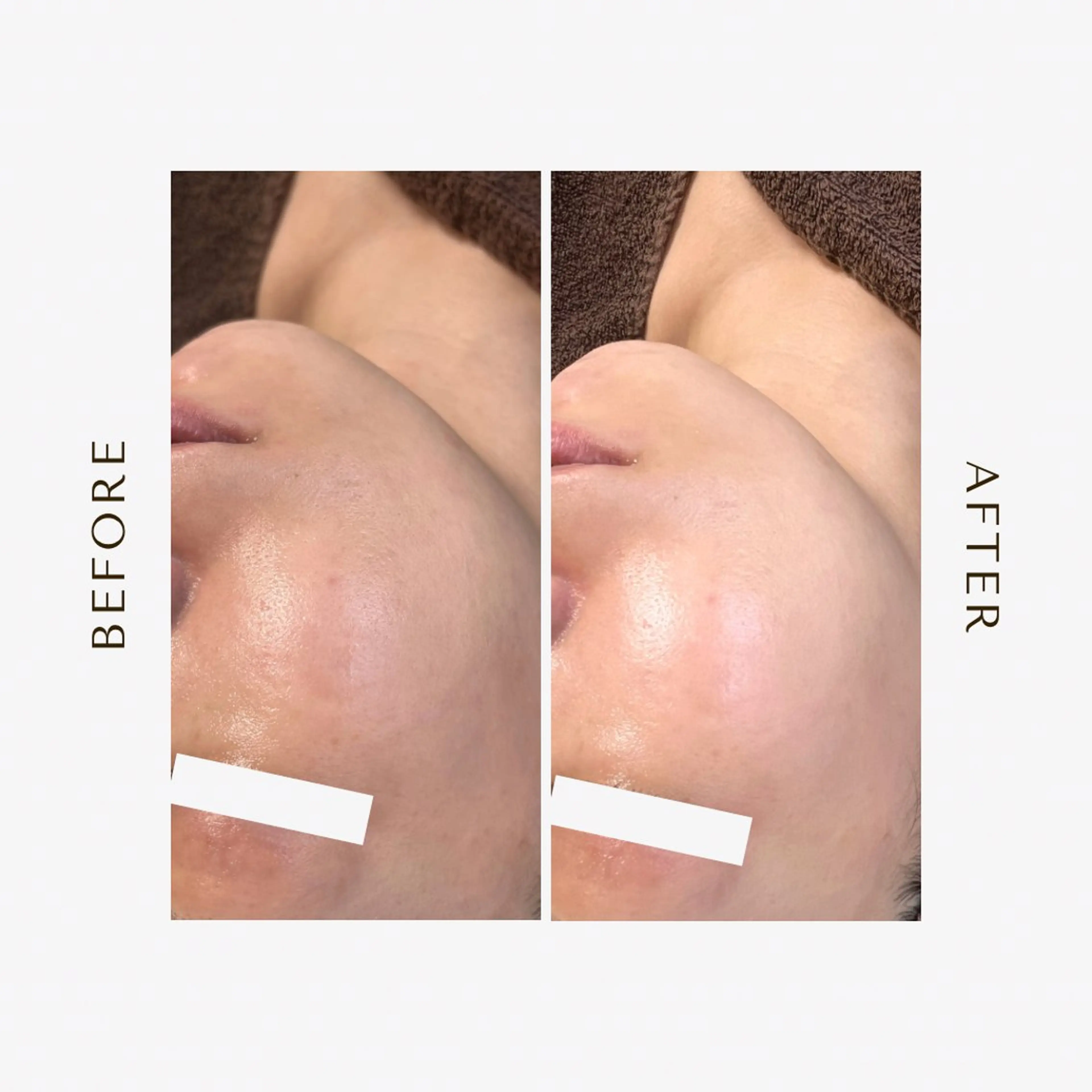 脱毛 1st｜フェイシャル エステ専門店のエステ・リラクイメージ