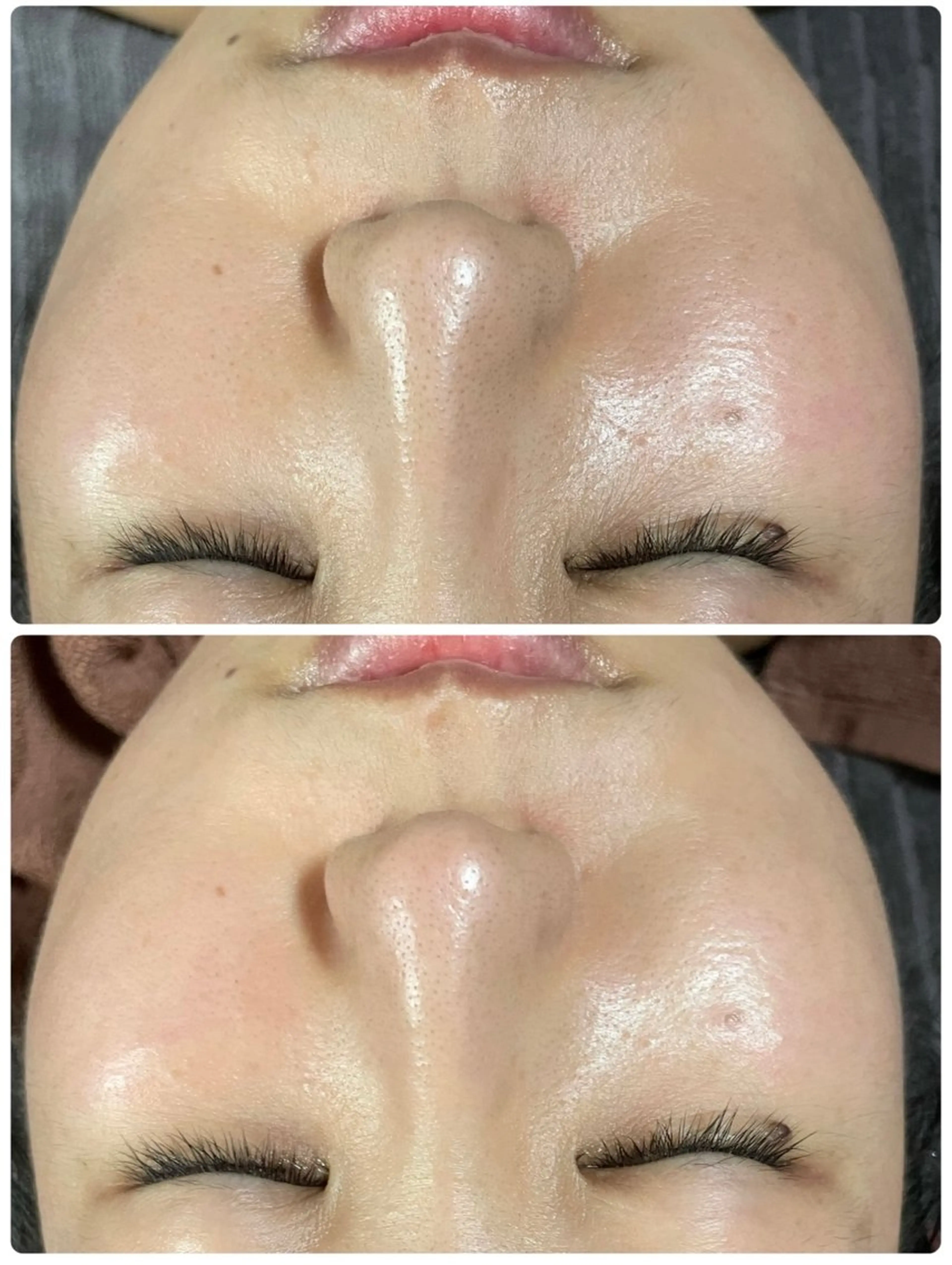 ✨ミニモ限定✨毛穴洗浄の写真