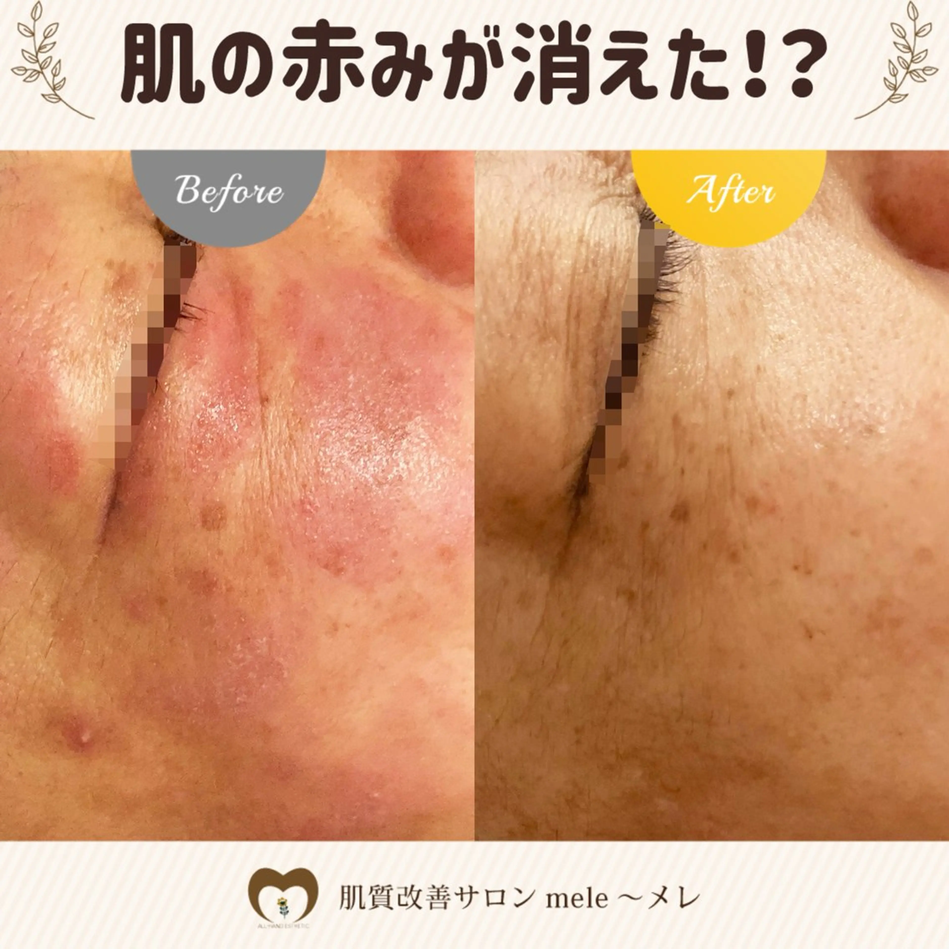 ニキビケア/毛穴/ 赤み/自信の肌✨森園のエステ・リラクイメージ