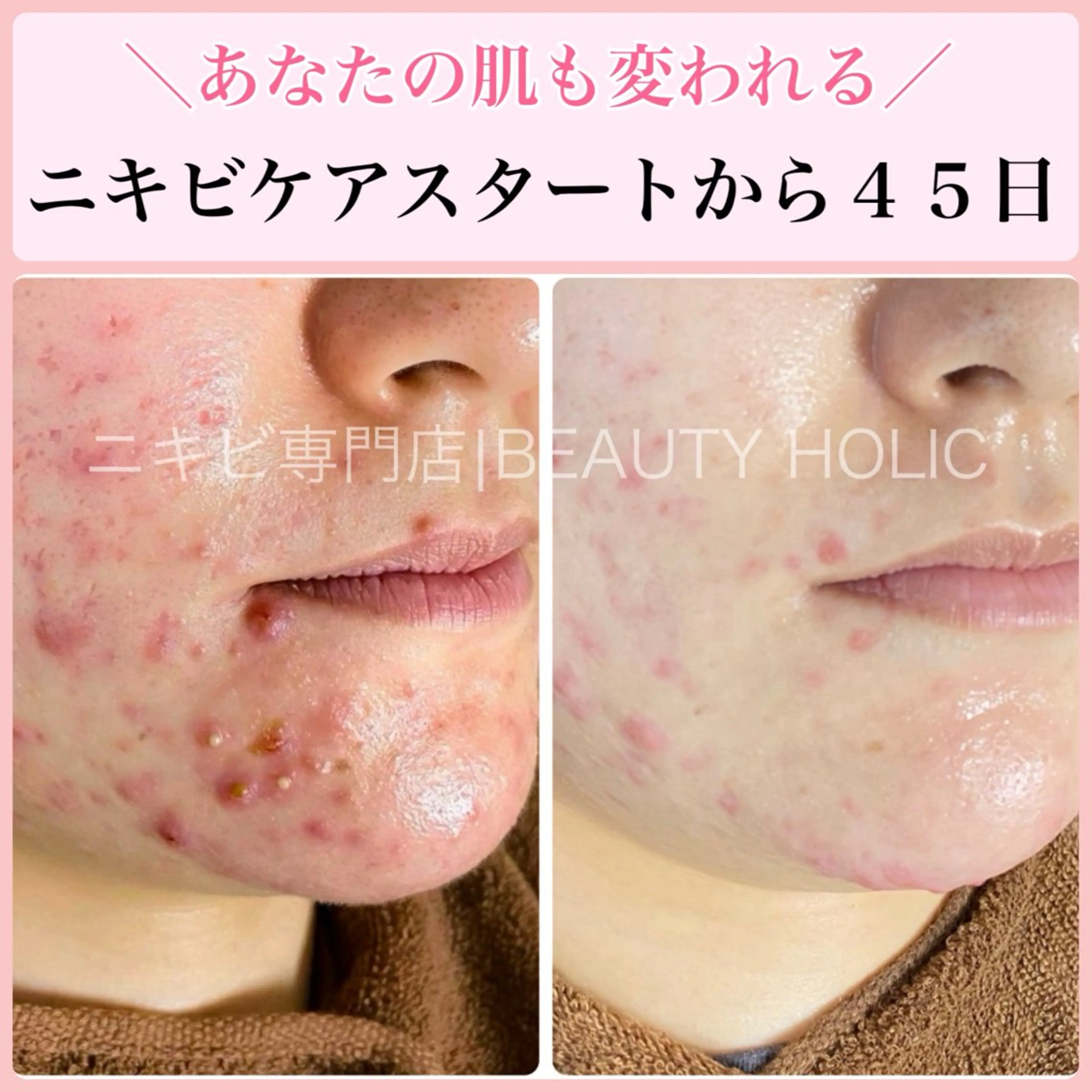 エステ リラク ニキビ・ 肌荒れ専門店のエステ・リラクイメージ