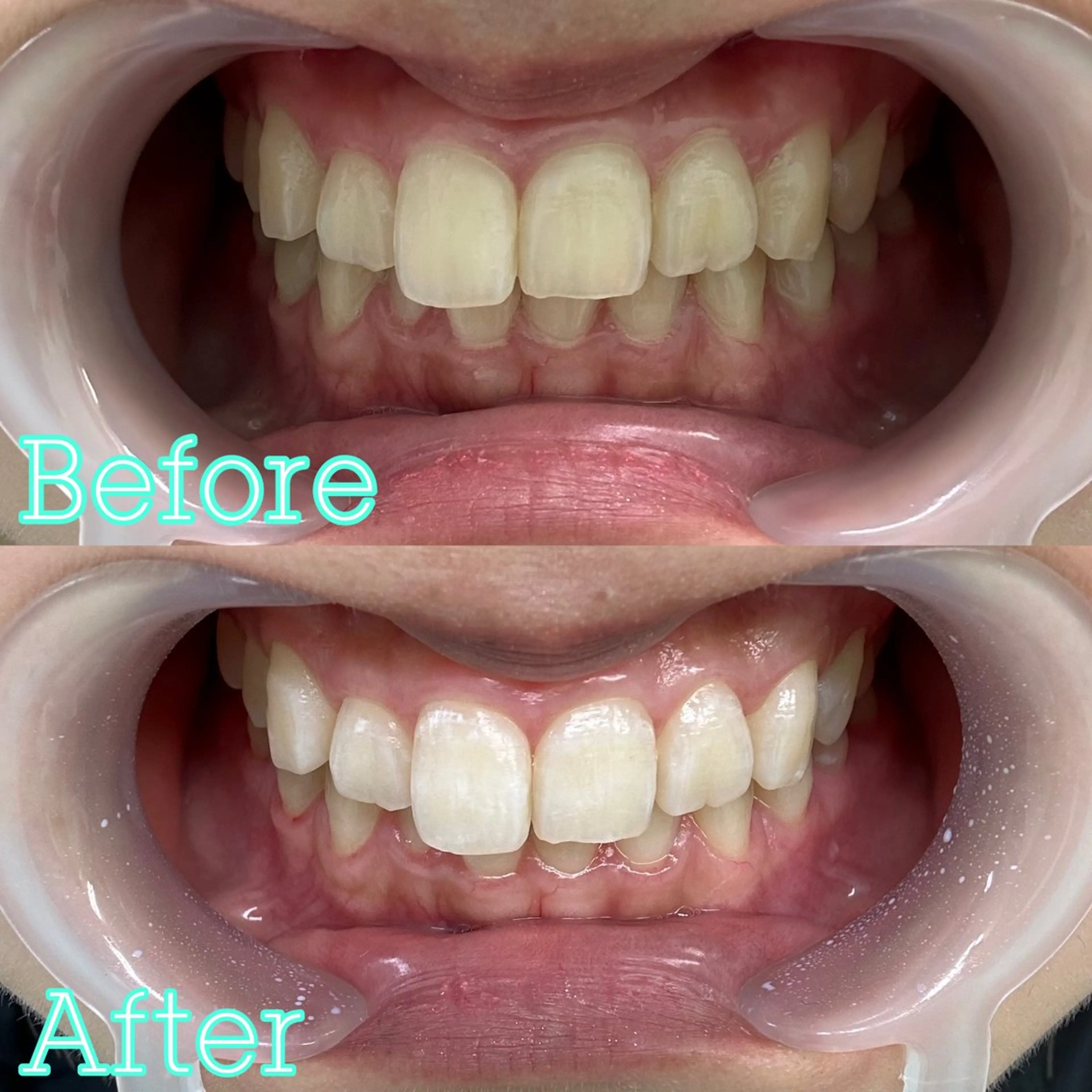 【回数券をお持ちの方】🌱美歯口ホワイトニング30分🌱の写真