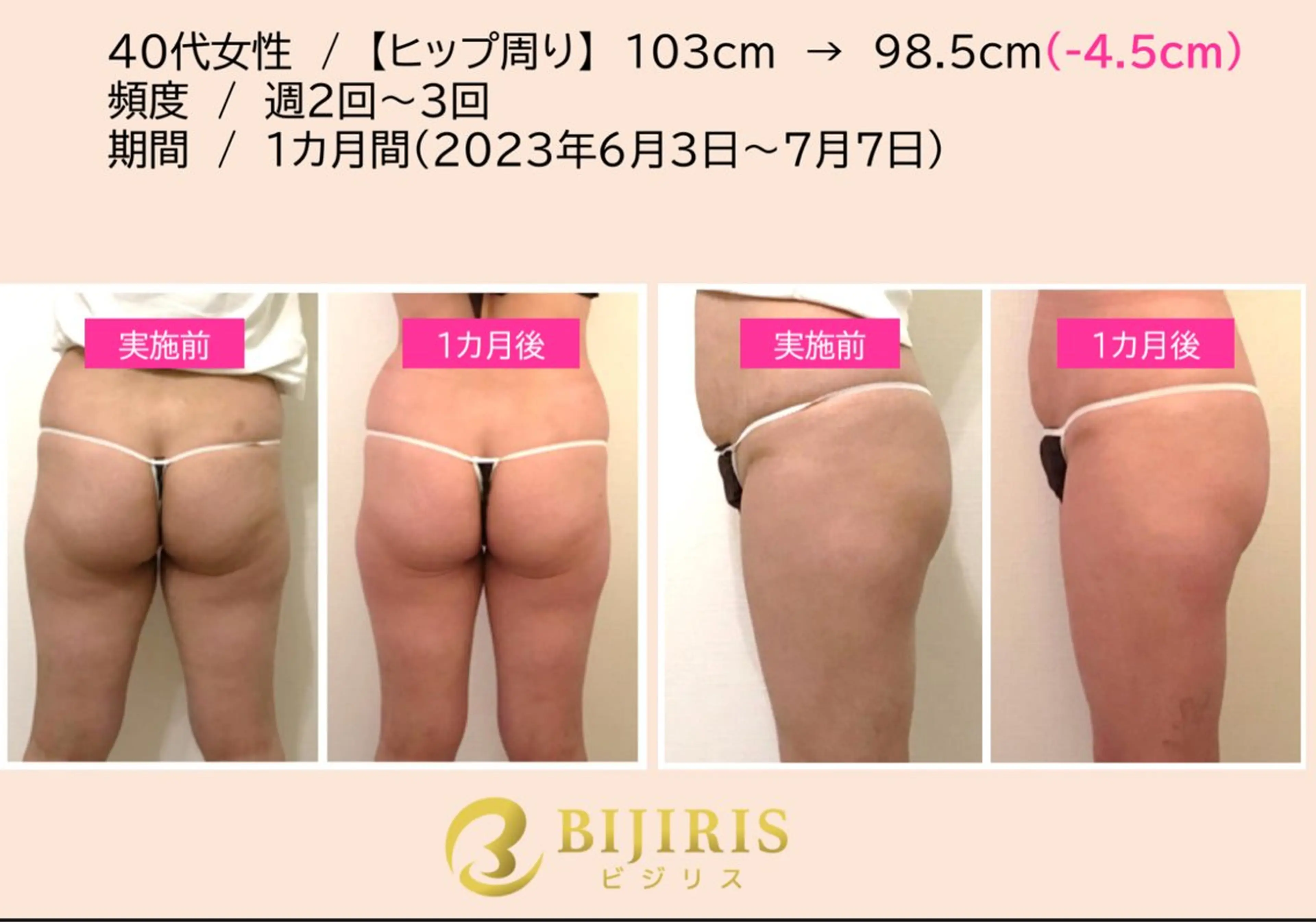 セルフ脱毛/美尻イス キングスサロン熊本のエステ・リラクイメージ