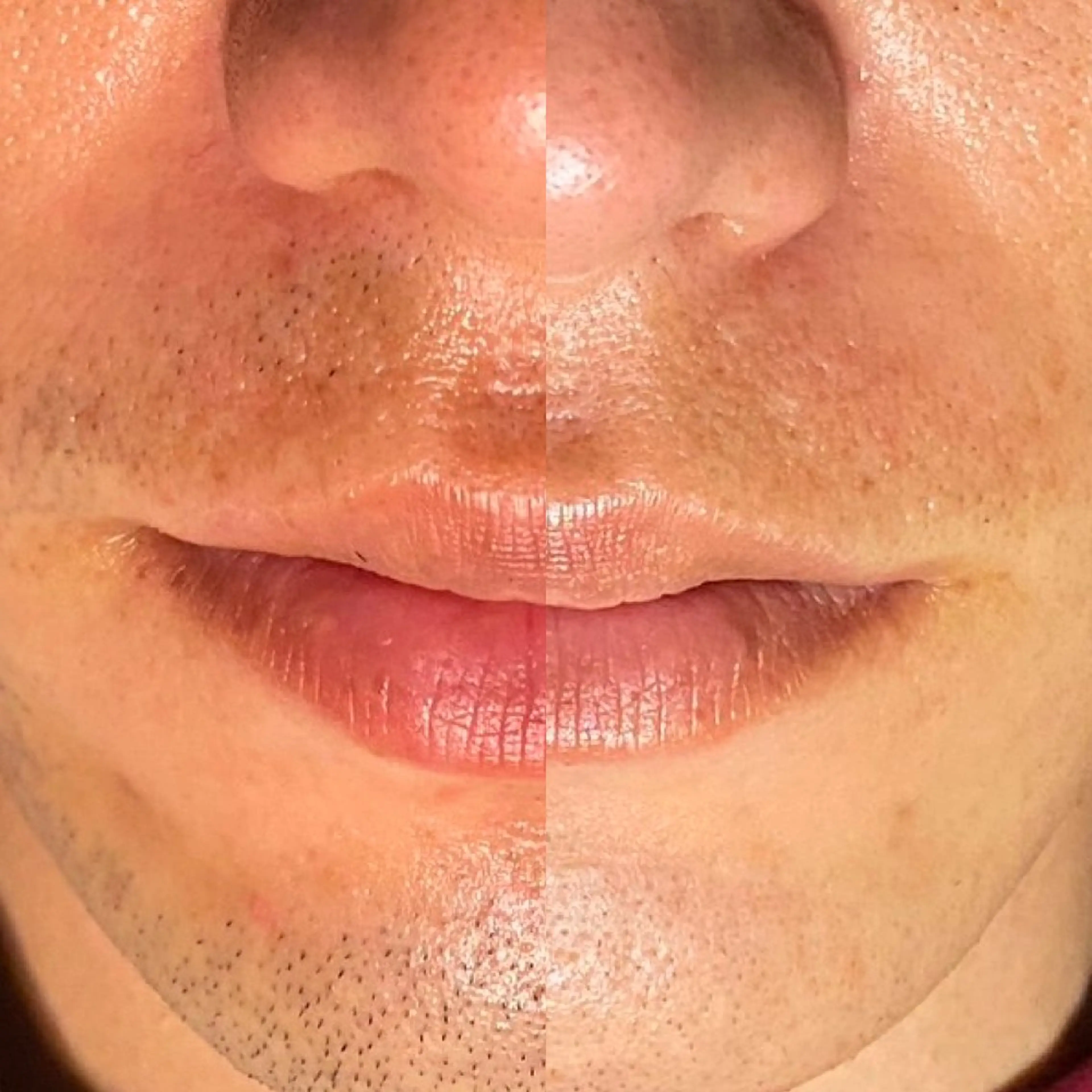 メンズ◆髭脱毛/頬​〜​顎下《細かい部位ケア込み鼻毛/耳毛/口周り》パック付✨の写真