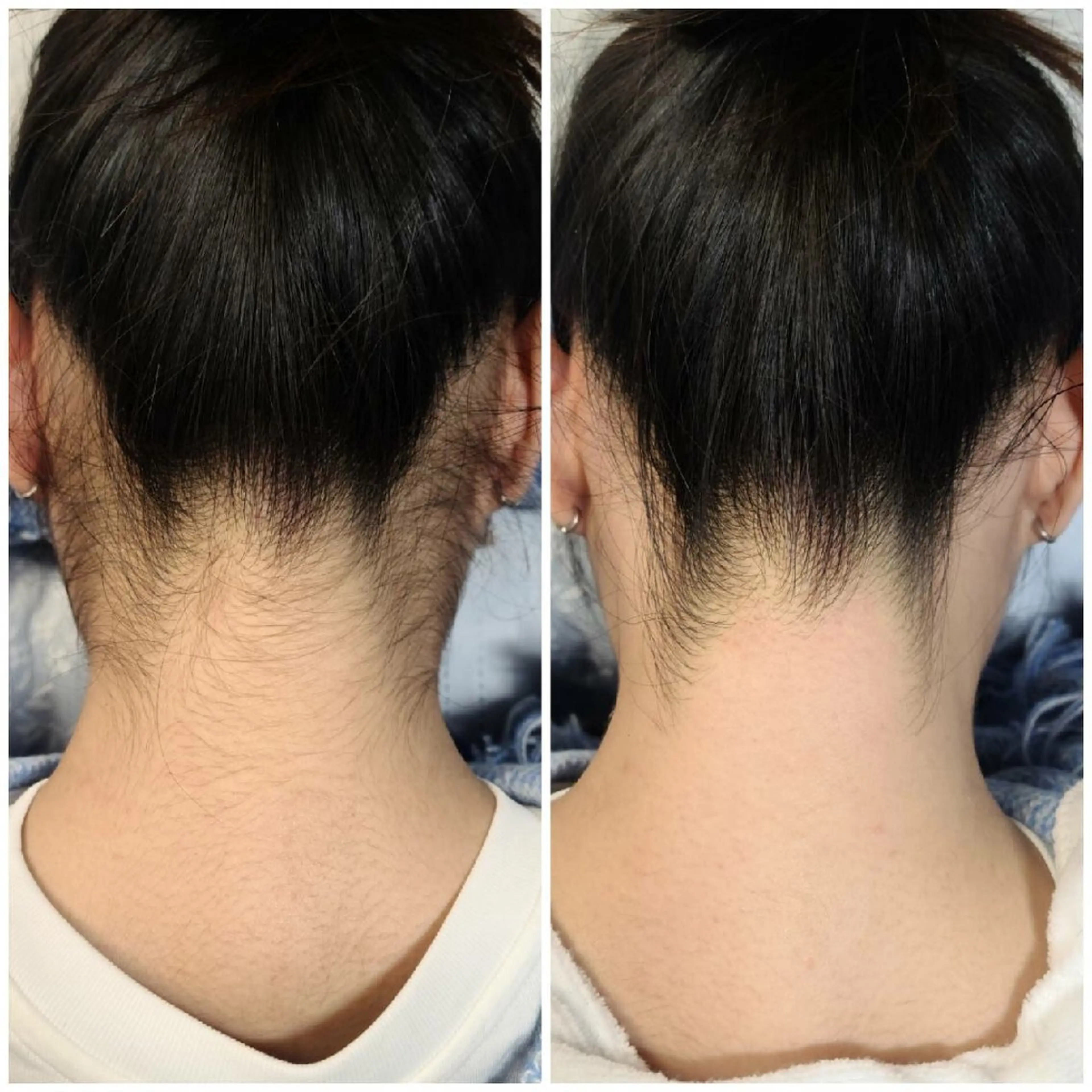 【ブラジリアンワックス｜シュガーリング】30分 うなじ脱毛の写真