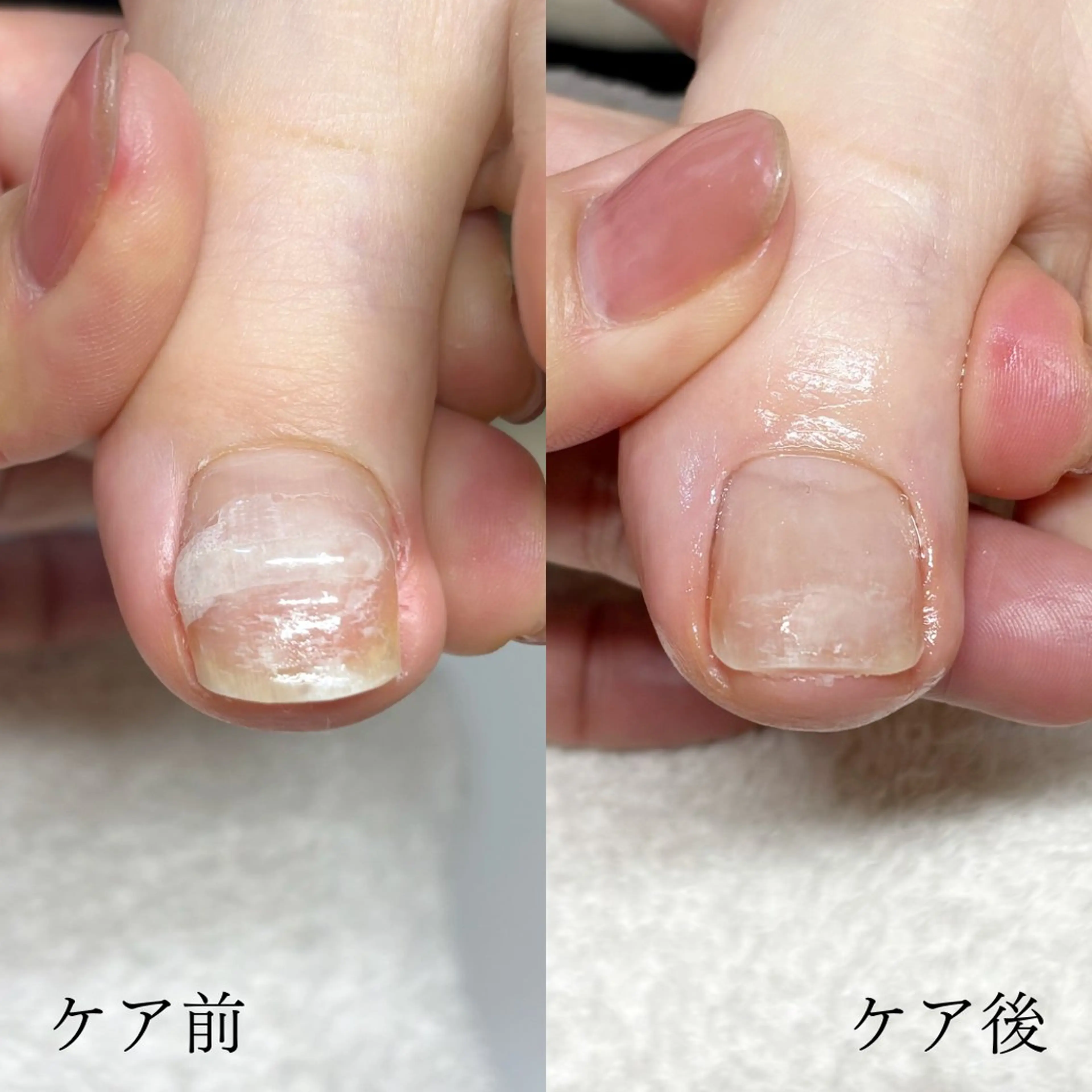 ネイル 深爪・巻き爪 専門サンセリテのネイルデザイン