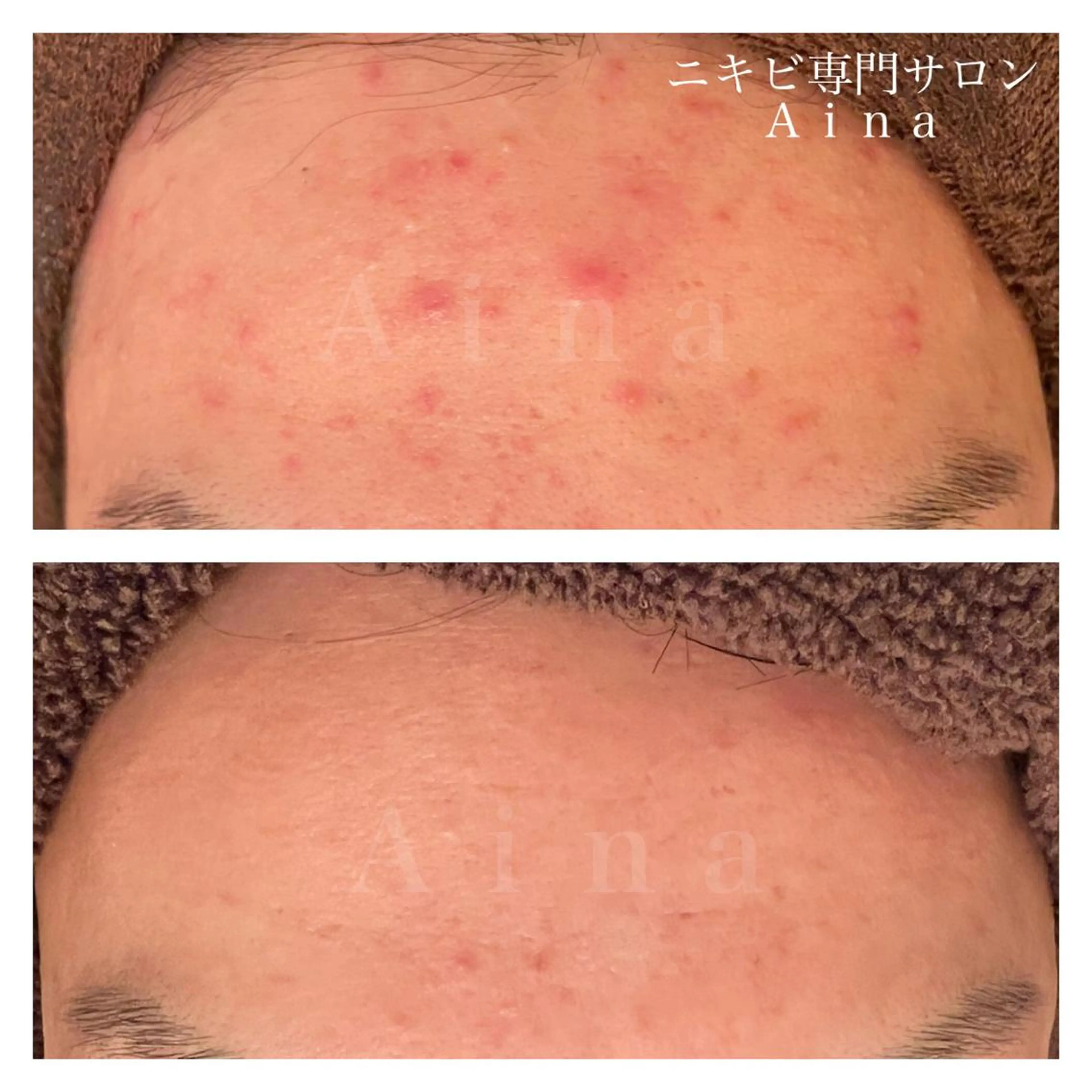 セミロング カラー パーマ ヘアアレンジ メンズ キッズ ネイル マツエク・マツパ アイブロウ エステ リラク ニキビ跡専門サロン Ainaのエステ・リラクイメージ