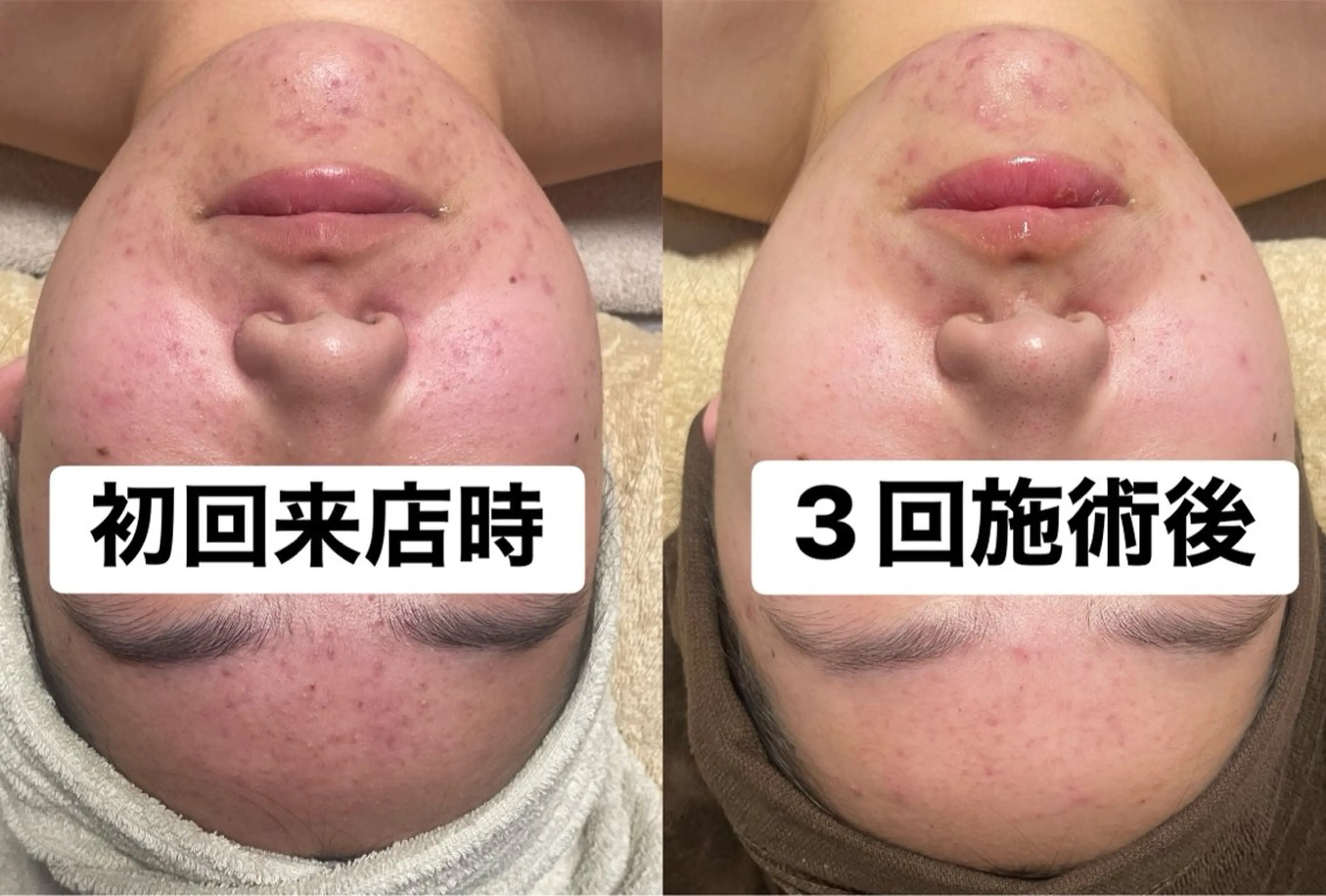 【モニター募集3回セット】本気の肌質改善🌿ハーブピーリング（剥離あり）＋フェイシャルマッサージ付の写真