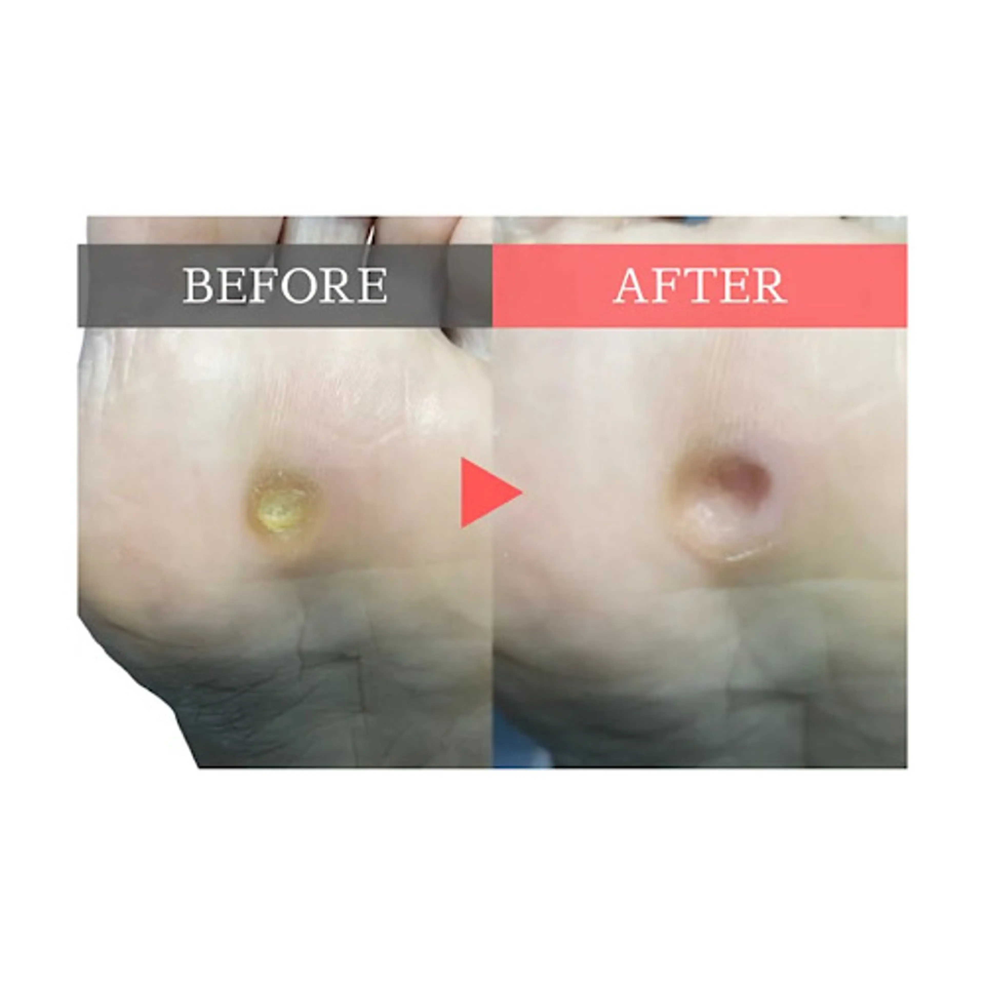 【足裏タコ・魚の目・踵の角質ケア＋爪切り】足裏全体の角質や痛い魚の目をキレイに取り除きます💁‍♀️の写真