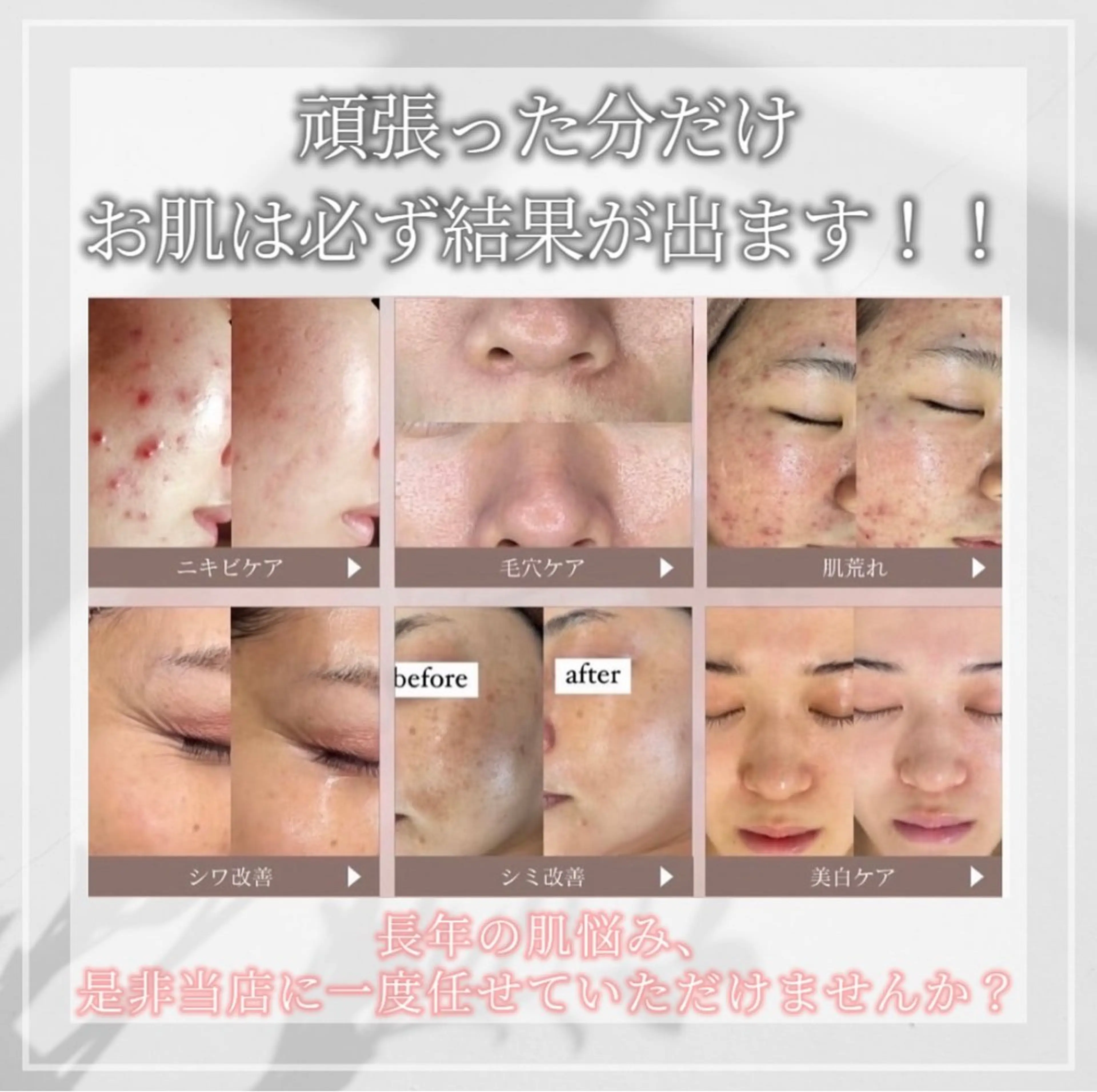 毛穴・ニキビケア　ハーブピーリング【肌管理専門店】WHITE AQUA鳳店所属・ホワイトアクア 鳳店のエステ・リラクイメージ