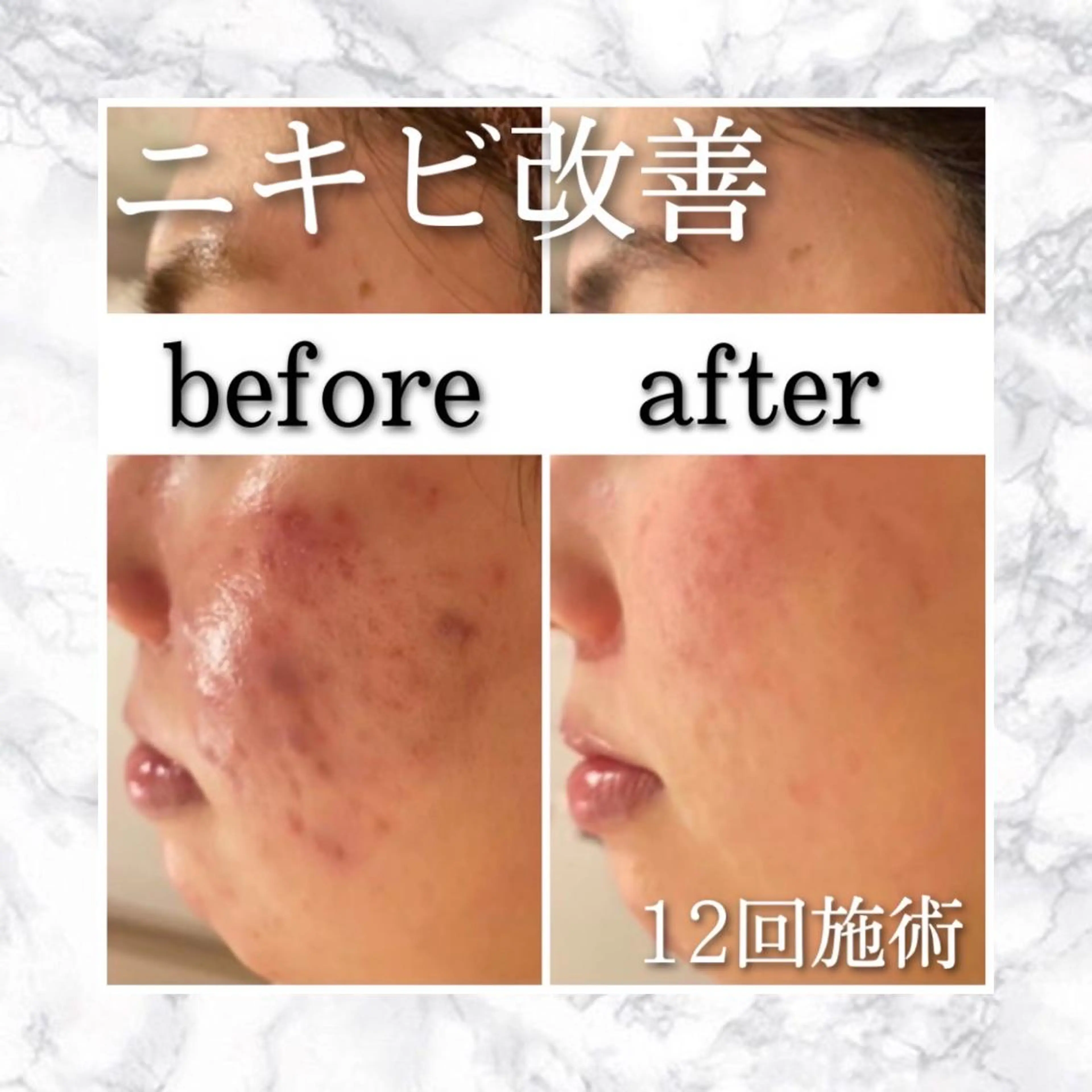 セミロング カラー パーマ ヘアアレンジ メンズ キッズ ネイル マツエク・マツパ アイブロウ 夏までに肌荒れ卒業 するサロン🌻のエステ・リラクイメージ