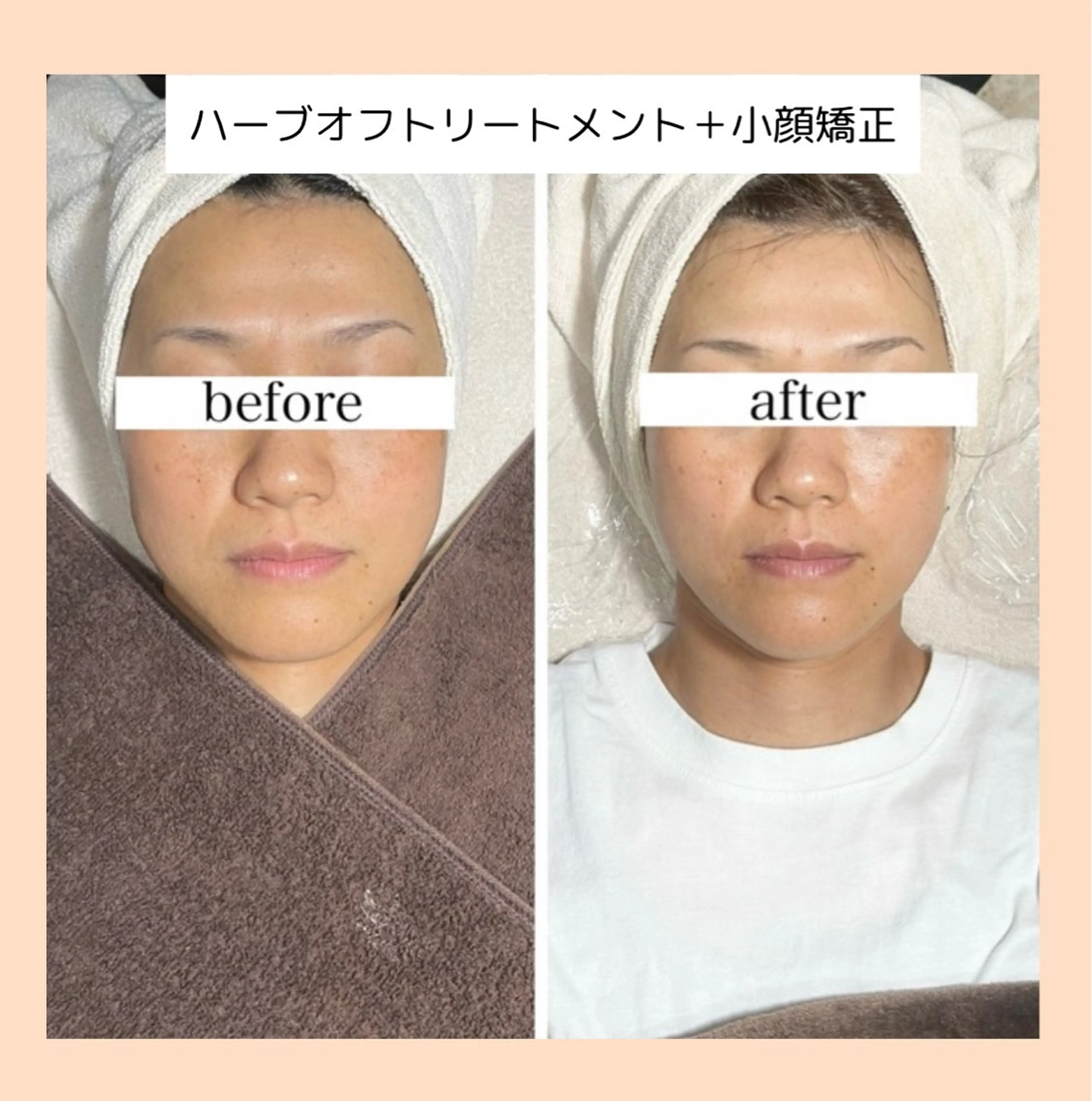 贅沢🌿ハーブオフトリートメント+矯正美顔マッサージの写真