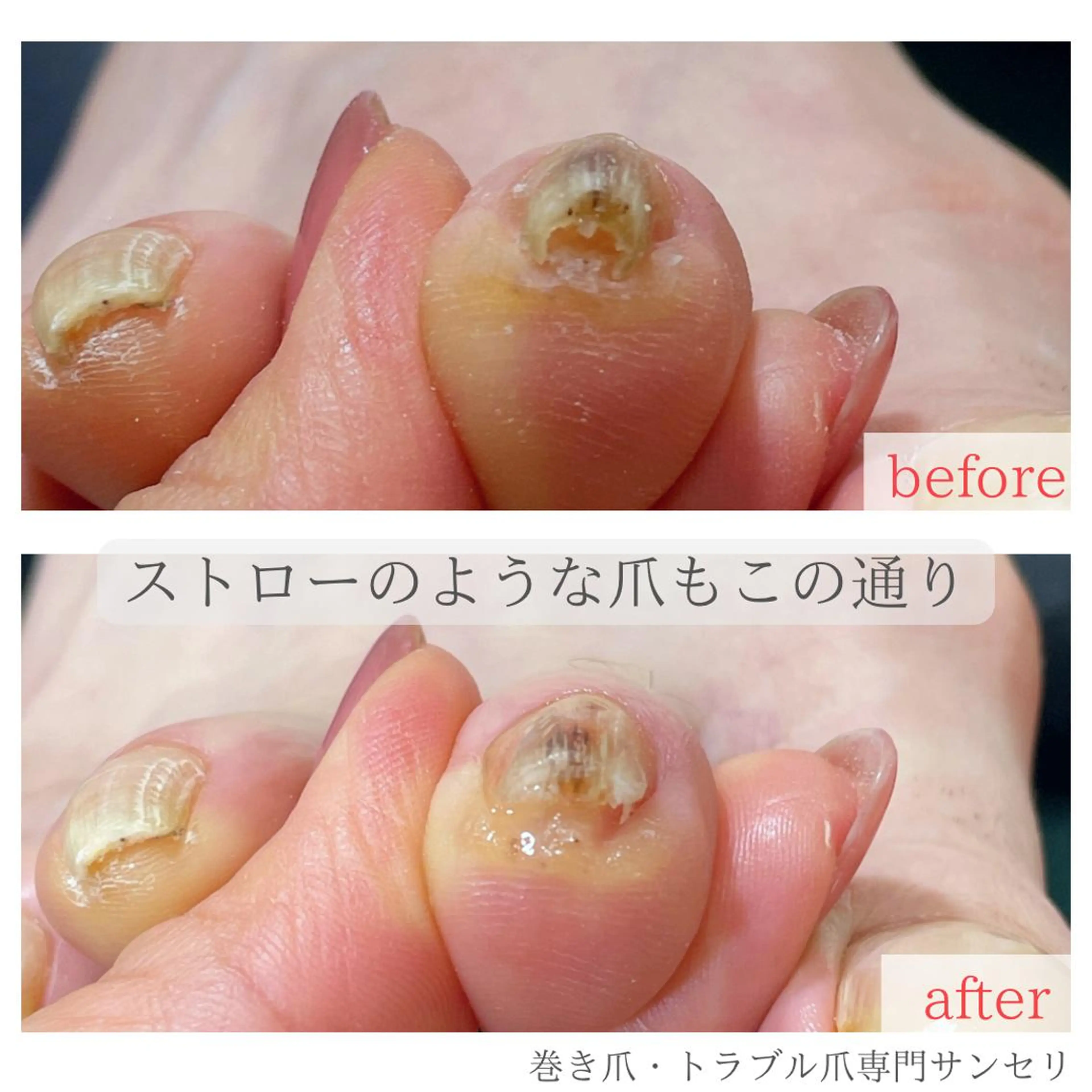 ネイル 深爪・巻き爪 専門サンセリテのネイルデザイン