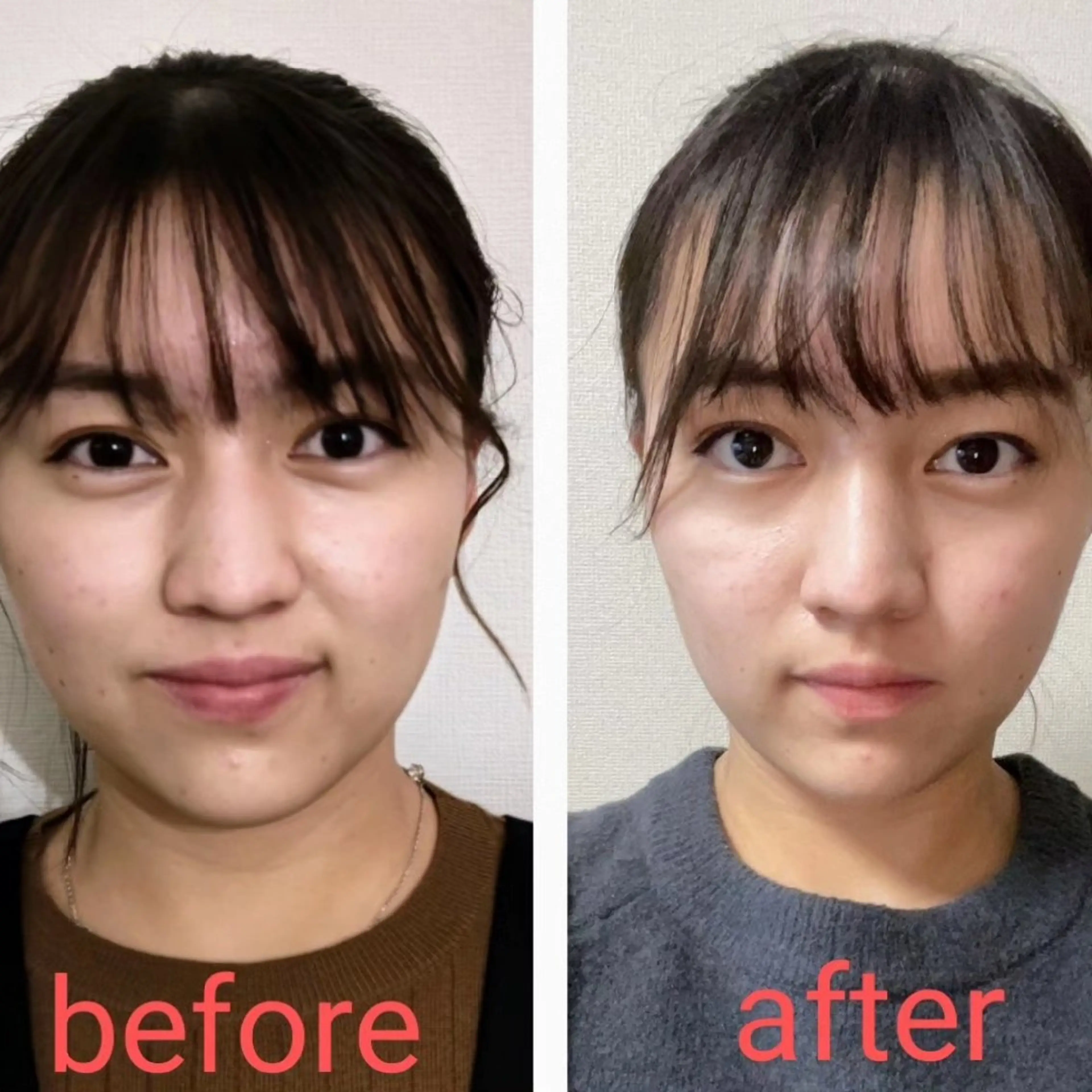 【顔ヤセ・スッキリ−3kg見え☆】小顔矯正＋リフトアップの写真