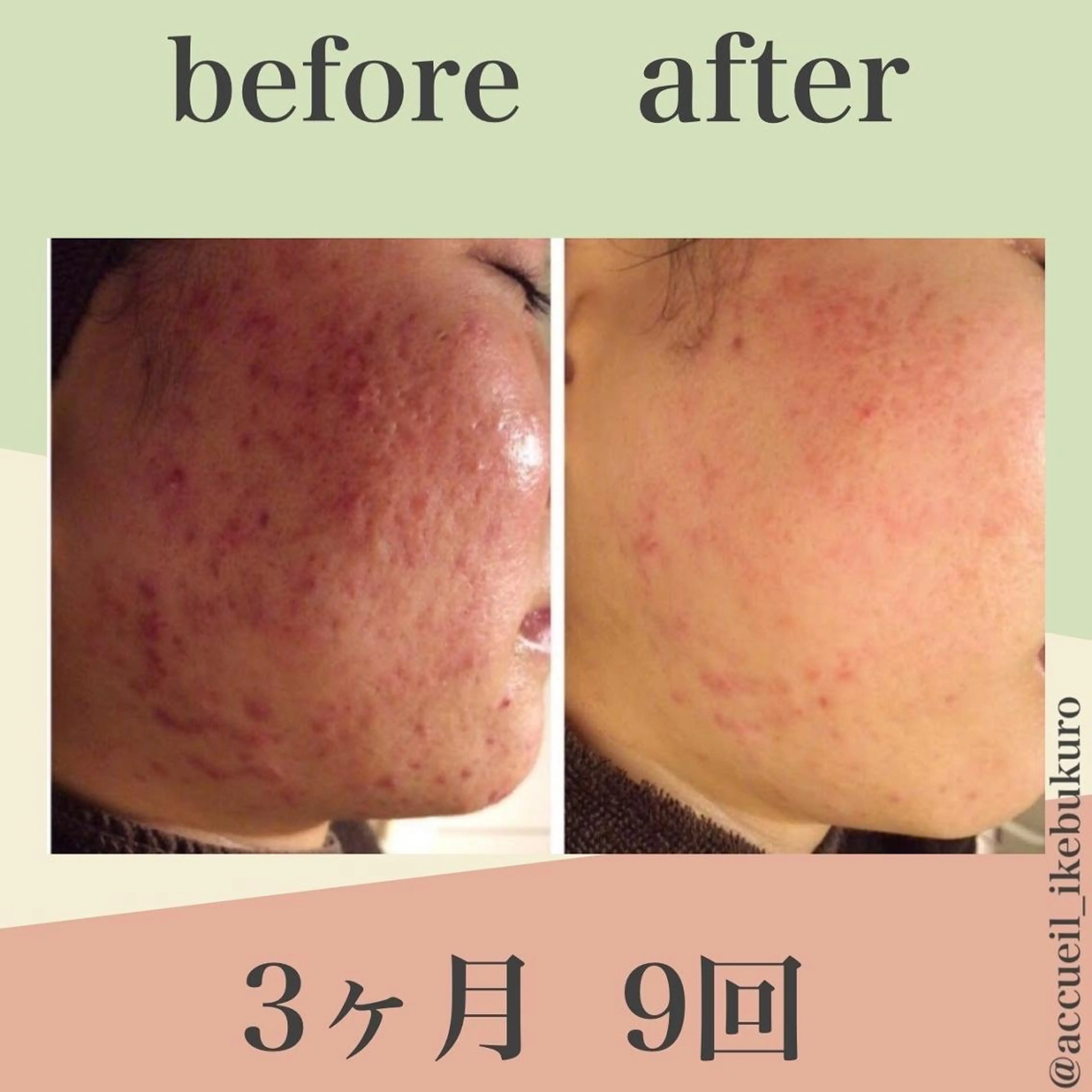 🔥3か月で肌革命 🔥ニキビ専門店のエステ・リラクイメージ