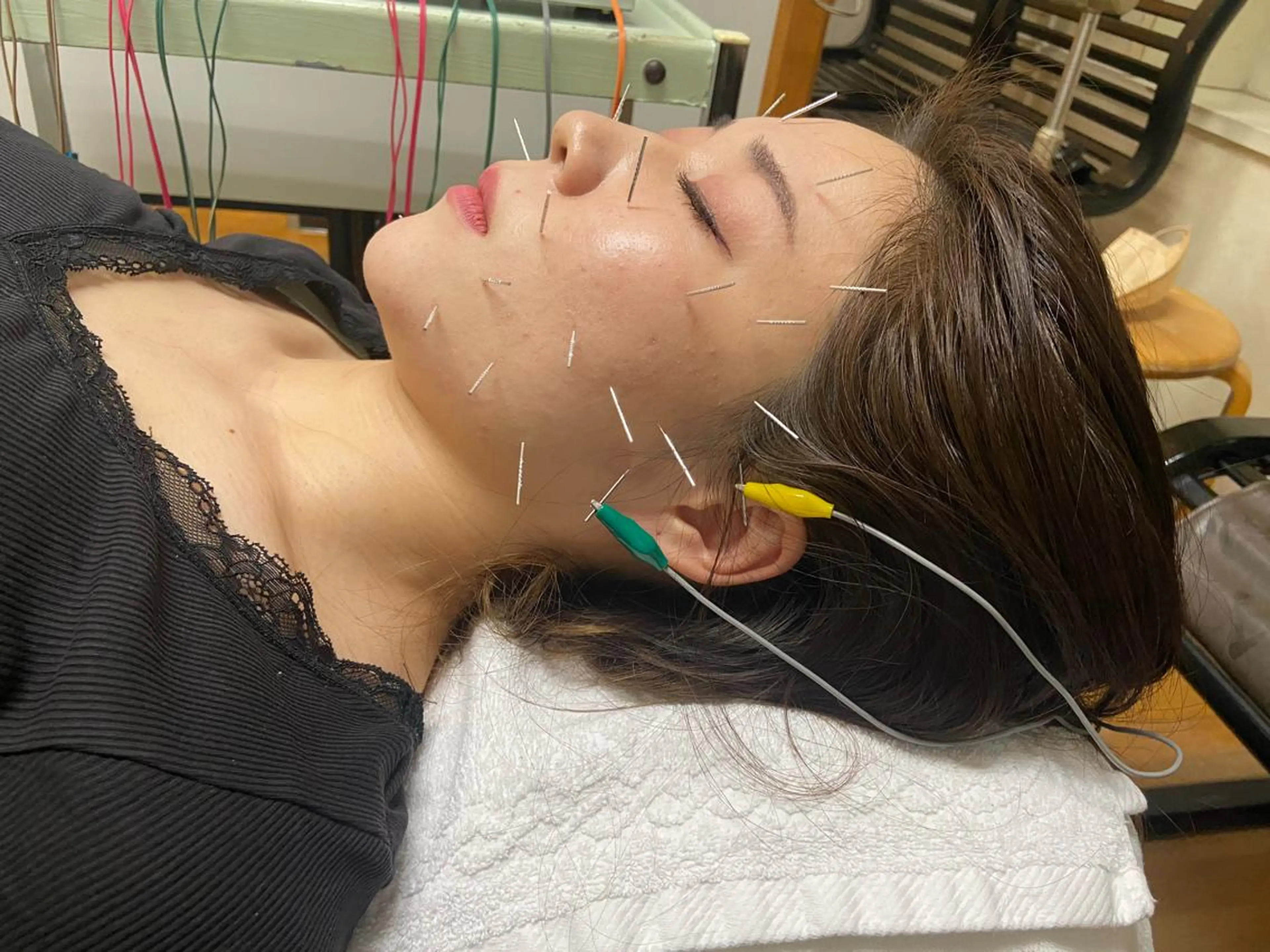 🪡小顔美容鍼【初回カウンセリング込み】の写真